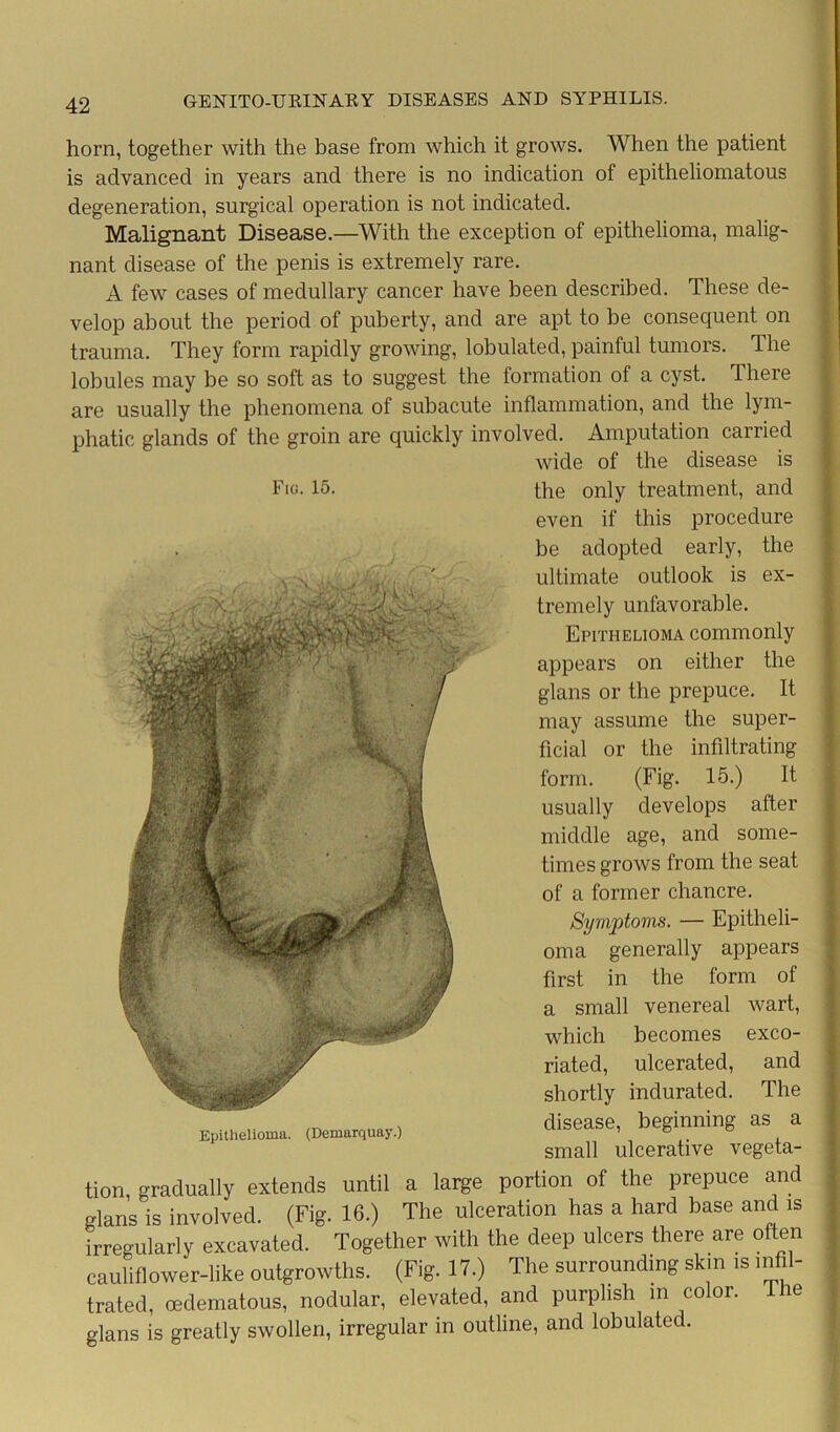 Fig. 15. horn, together with the base from which it grows. When the patient is advanced in years ancl there is no indication of epitheliomatous degeneration, surgical operation is not indicated. Malignant Disease.—With the exception of epithelioma, malig- nant disease of the penis is extremely rare. A few cases of medullary cancer have been described. These de- velop about the period of puberty, and are apt to be consequent on trauma. They form rapidly growing, lobulated, painful tumors. The lobules may be so soft as to suggest the formation of a cyst. There are usually the phenomena of subacute inflammation, and the lym- phatic glands of the groin are quickly involved. Amputation carried wide of the disease is the only treatment, and even if this procedure be adopted early, the ultimate outlook is ex- tremely unfavorable. Epithelioma commonly appears on either the glans or the prepuce. It may assume the super- ficial or the infiltrating form. (Fig. 15.) It usually develops after middle age, and some- times grows from the seat of a former chancre. Symptoms. — Epitheli- oma generally appears first in the form of small venereal wart, exco- and The as a Epithelioma. (Demarquay.) which becomes riated, ulcerated, shortly indurated, disease, beginning small ulcerative vegeta- tion, gradually extends until a large portion of the prepuce and glans is involved. (Fig. 16.) The ulceration has a hard base and is irregularly excavated. Together with the deep ulcers there are often cauliflower-like outgrowths. (Fig. 17.) The surrounding skin is infil- trated, oedematous, nodular, elevated, and purplish in color, the glans is greatly swollen, irregular in outline, and lobulated.