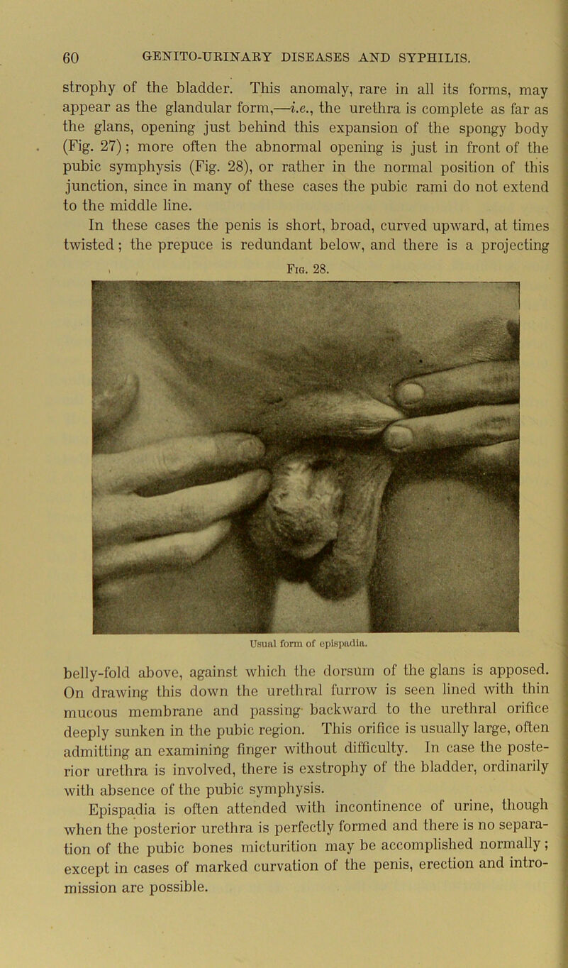 Usual form of epispadia. belly-fold above, against which the dorsum of the glans is apposed. On drawing this down the urethral furrow is seen lined with thin mucous membrane and passing- backward to the urethral orifice deeply sunken in the pubic region. This orifice is usually large, often admitting an examining finger without difficulty. In case the poste- rior urethra is involved, there is exstrophy of the bladder, ordinarily with absence of the pubic symphysis. Epispadia is often attended with incontinence of urine, though when the posterior urethra is perfectly formed and there is no separa- tion of the pubic bones micturition may be accomplished normally; except in cases of marked curvation of the penis, erection and intro- mission are possible. 60 GENITO-URINARY DISEASES AND SYPHILIS. strophy of the bladder. This anomaly, rare in all its forms, may appear as the glandular form,—i.e., the urethra is complete as far as the glans, opening just behind this expansion of the spongy body (Fig. 27); more often the abnormal opening is just in front of the pubic symphysis (Fig. 28), or rather in the normal position of this junction, since in many of these cases the pubic rami do not extend to the middle line. In these cases the penis is short, broad, curved upward, at times twisted; the prepuce is redundant below, and there is a projecting