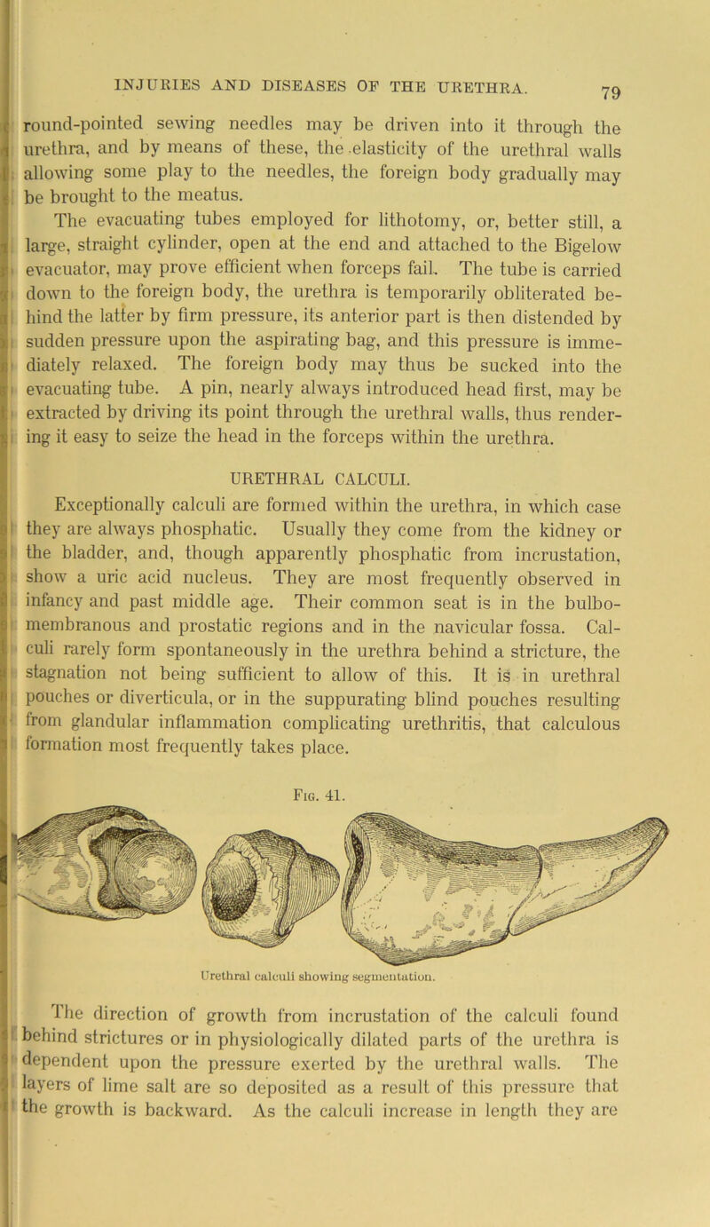 79 round-pointed sewing needles may be driven into it through the urethra, and by means of these, the .elasticity of the urethral walls , allowing some play to the needles, the foreign body gradually may be brought to the meatus. The evacuating tubes employed for lithotomy, or, better still, a large, straight cylinder, open at the end and attached to the Bigelow • evacuator, may prove efficient when forceps fail The tube is carried down to the foreign body, the urethra is temporarily obliterated be- hind the latter by firm pressure, its anterior part is then distended by ! sudden pressure upon the aspirating bag, and this pressure is imme- ■ diately relaxed. The foreign body may thus be sucked into the i evacuating tube. A pin, nearly always introduced head first, may be i extracted by driving its point through the urethral walls, thus render- i ing it easy to seize the head in the forceps within the urethra. URETHRAL CALCULI. Exceptionally calculi are formed within the urethra, in which case they are always phosphatic. Usually they come from the kidney or the bladder, and, though apparently phosphatic from incrustation, show a uric acid nucleus. They are most frequently observed in infancy and past middle age. Their common seat is in the bulbo- membranous and prostatic regions and in the navicular fossa. Cal- culi rarely form spontaneously in the urethra behind a stricture, the stagnation not being sufficient to allow of this. It is in urethral pouches or diverticula, or in the suppurating blind pouches resulting from glandular inflammation complicating urethritis, that calculous formation most frequently takes place. Fig. 41. Urethral calculi showing segmentation. The direction of growth from incrustation of the calculi found behind strictures or in physiologically dilated parts of the urethra is ' dependent upon the pressure exerted by the urethral Avails. The layers of lime salt are so deposited as a result of this pressure that the groAvth is backward. As the calculi increase in length they are