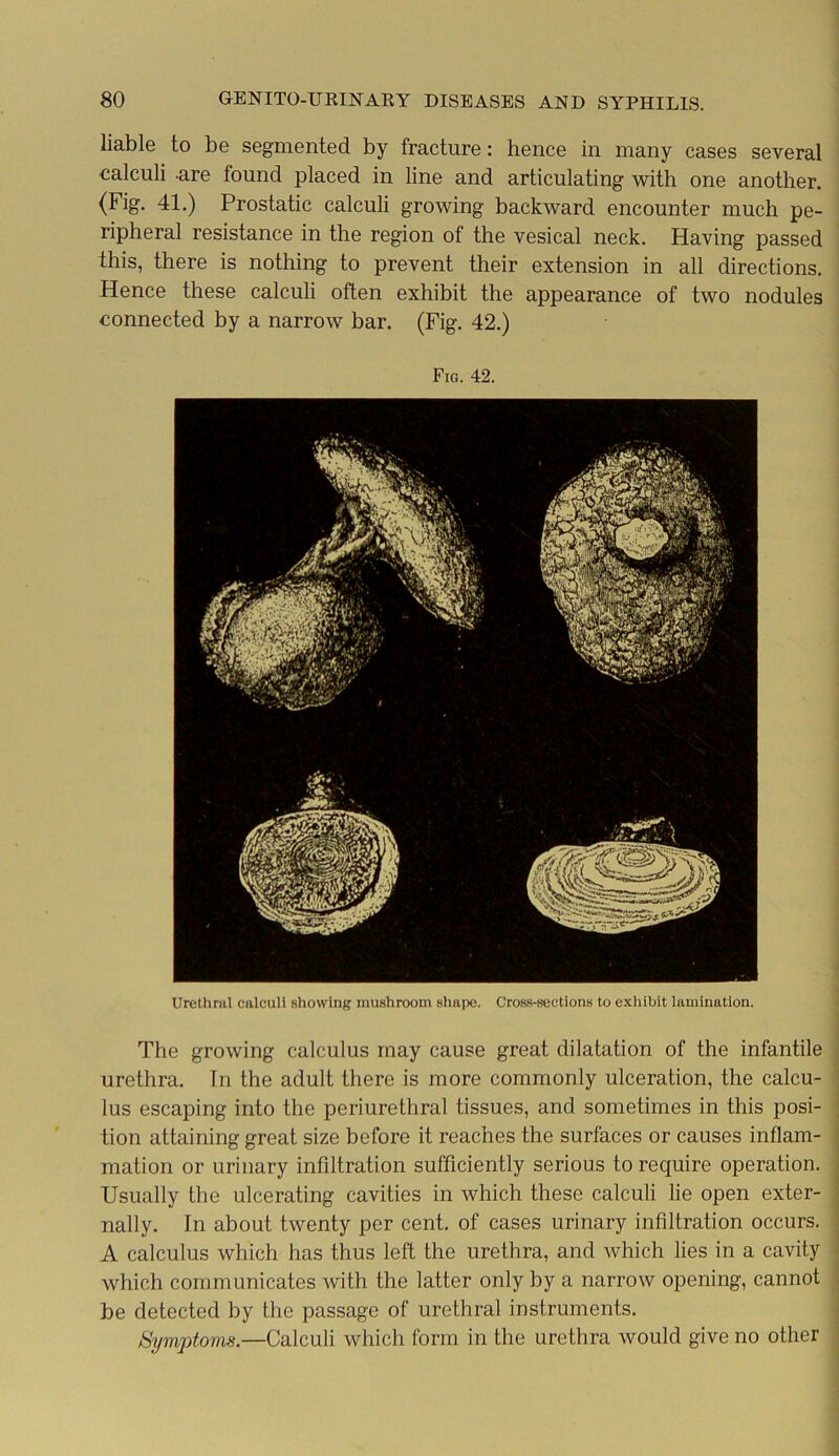 liable to be segmented by fracture: hence in many cases several calculi -are found placed in line and articulating with one another. (Fig. 41.) Prostatic calculi growing backward encounter much pe- ripheral resistance in the region of the vesical neck. Having passed this, there is nothing to prevent their extension in all directions. Hence these calculi often exhibit the appearance of two nodules connected by a narrow bar. (Fig. 42.) Fig. 42. Urethral calculi showing mushroom shape. Cross-sections to exhibit lamination. The growing calculus may cause great dilatation of the infantile urethra. In the adult there is more commonly ulceration, the calcu- lus escaping into the periurethral tissues, and sometimes in this posi- tion attaining great size before it reaches the surfaces or causes inflam- mation or urinary infiltration sufficiently serious to require operation. Usually the ulcerating cavities in which these calculi lie open exter- nally. In about twenty per cent, of cases urinary infiltration occurs. A calculus which has thus left the urethra, and which lies in a cavity which communicates with the latter only by a narrow opening, cannot be detected by the passage of urethral instruments. Symptoms.—Calculi which form in the urethra would give no other