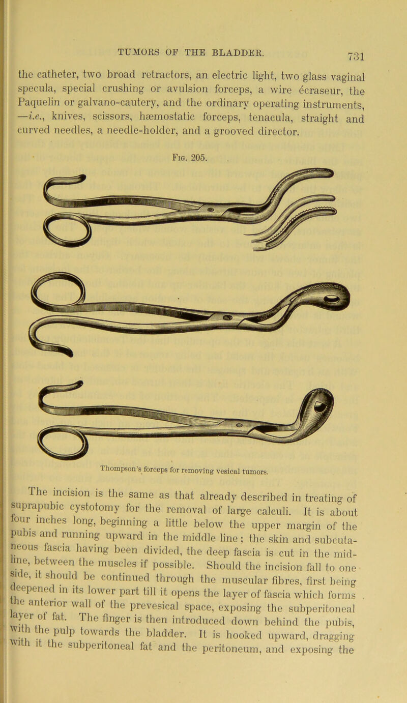 731 the catheter, two broad retractors, an electric light, two glass vaginal specula, special crushing or avulsion forceps, a wire ecraseur, the Paquelin or galvano-cautery, and the ordinary operating instruments, knives, scissors, haemostatic forceps, tenacula, straight and curved needles, a needle-holder, and a grooved director. Fig. 205. lhompson’s forceps for removing vesical tumors. The incision is the same as that already described in treating of suprapubic cystotomy for the removal of large calculi. It is about lour inches long, beginning a little below the upper margin of the pubis and running upward in the middle line; the skin and subcuta- neous fasaa having been divided, the deep fascia is cut in the mid- line, between the muscles if possible. Should the incision fall to one side, it should be continued through the muscular fibres, first being deepened in its lower part till it opens the layer of fascia which forms e an erior wall of the prevesical space, exposing the subperitoneal ayer of fat. The finger is then introduced down behind the pubis, ! e Pulp towards the bladder. It is hooked upward, dragging