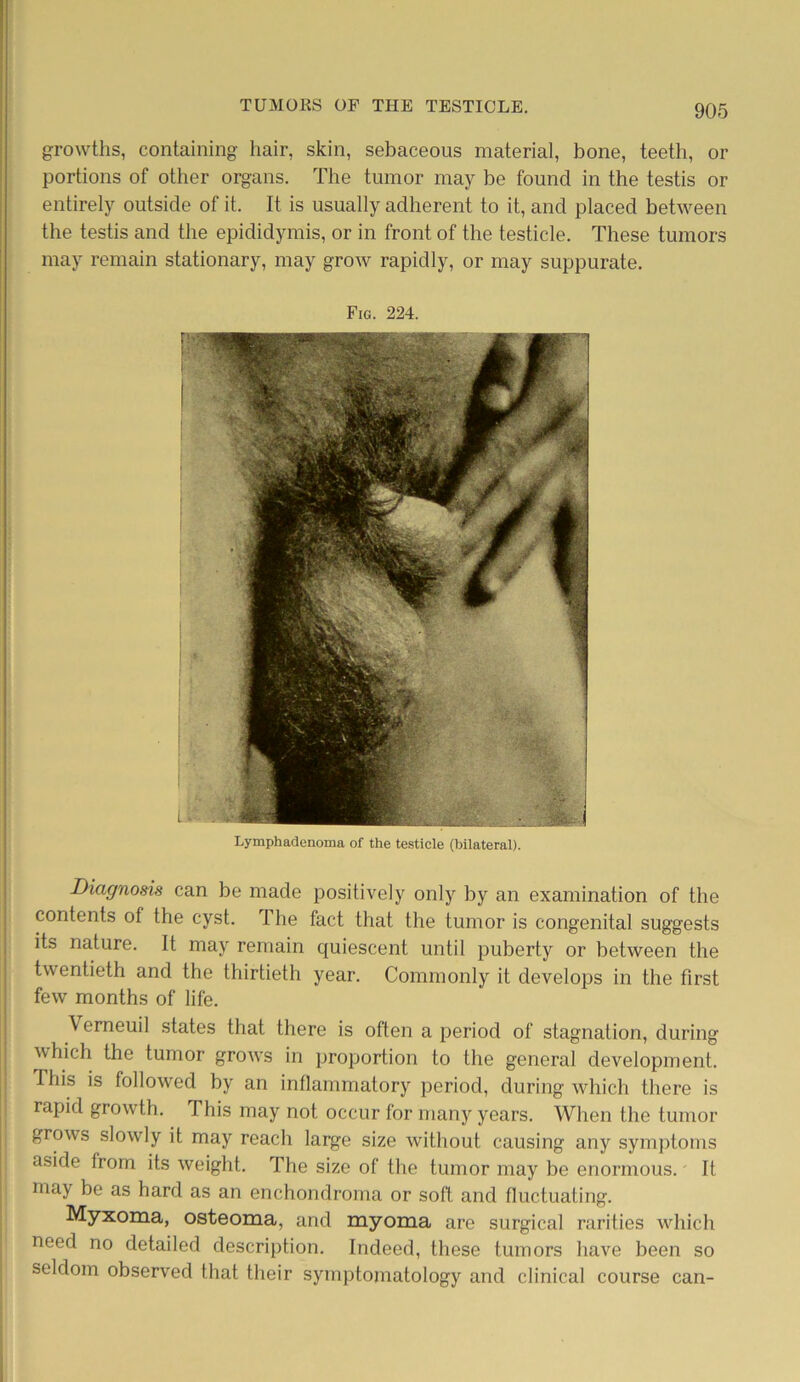 growths, containing hair, skin, sebaceous material, bone, teeth, or portions of other organs. The tumor may be found in the testis or entirely outside of it. It is usually adherent to it, and placed between the testis and the epididymis, or in front of the testicle. These tumors may remain stationary, may grow rapidly, or may suppurate. Fig. 224. Lymphadenoma of the testicle (bilateral). Diagnosis can be made positively only by an examination of the contents of the cyst. The fact that the tumor is congenital suggests its nature. It may remain quiescent until puberty or between the twentieth and the thirtieth year. Commonly it develops in the first few months of life. Verneuil states that there is often a period of stagnation, during which the tumor grows in proportion to the general development. This is followed by an inflammatory period, during which there is rapid growth. This may not occur for many years. When the tumor grows slowly it may reach large size without causing any symptoms aside from its weight. The size of the tumor may be enormous. It may be as hard as an enchondroma or soft and fluctuating. Myxoma, osteoma, and myoma are surgical rarities which need no detailed description. Indeed, these tumors have been so seldom observed that their symptomatology and clinical course can-