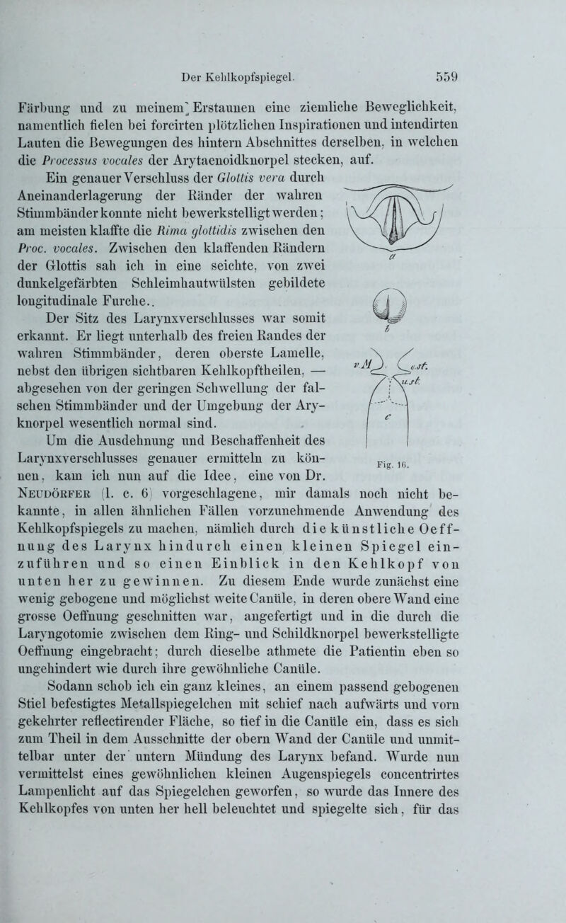 Färbung und zu meinenU Erstaunen eine ziemliche Beweglichkeit, namentlich fielen bei forcirten plötzlichen Inspirationen und intendirten Lauten die Bewegungen des hintern Abschnittes derselben, in welchen die Processus vocales der Arytaenoidknorpel stecken, auf. Ein genauer Verschluss der Glottis vera durch Aneinanderlagerung der Ränder der wahren Stimmbänder konnte nicht bewerkstelligt werden; am meisten klaffte die Rima glottidis zwischen den Proc. vocales. Zwischen den klaffenden Rändern der Glottis sah ich in eine seichte, von zwei dunkelgefärbten Schleimhautwülsten gebildete longitudinale Furche.. Der Sitz des Larynxverschlusses war somit erkannt. Er liegt unterhalb des freien Randes der wahren Stimmbänder, deren oberste Lamelle, nebst den übrigen sichtbaren Kelilkopftheilen, — abgesehen von der geringen Schwellung der fal- schen Stimmbänder und der Umgebung der Ary- knorpel wesentlich normal sind. Um die Ausdehnung und Beschaffenheit des Larynxverschlusses genauer ermitteln zu kön- nen, kam ich nun auf die Idee, eine von Dr. Neudörfer (1. c. 6 vorgeschlagene, mir damals noch nicht be- kannte, in allen ähnlichen Fällen vorzunehmende Anwendung des Kehlkopfspiegels zu machen, nämlich durch die künstliche Oeff- nung des Larynx hindurch einen kleinen Spiegel ein- zuführen und so einen Einblick in den Kehlkopf von unten her zu gewinnen. Zu diesem Ende wurde zunächst eine wenig gebogene und möglichst weite Canüle, in deren obere Wand eine grosse Oefifnung geschnitten war, angefertigt und in die durch die Laryngotomie zwischen dem Ring- und Schildknorpel bewerkstelligte Oefifnung eingebracht; durch dieselbe athmete die Patientin eben so ungehindert wie durch ihre gewöhnliche Canüle. Sodann schob ich ein ganz kleines, an einem passend gebogenen Stiel befestigtes Metallspiegelchen mit schief nach aufwärts und vorn gekehrter reflectirender Fläche, so tief in die Canüle ein, dass es sich zum Theil in dem Ausschnitte der obern Wand der Canüle und unmit- telbar unter der untern Mündung des Larynx befand. Wurde nun vermittelst eines gewöhnlichen kleinen Augenspiegels concentrirtes Lampenlicht auf das Spiegelchen geworfen, so wurde das Innere des Kehlkopfes von unten her hell beleuchtet und spiegelte sich, für das Fig. 16.