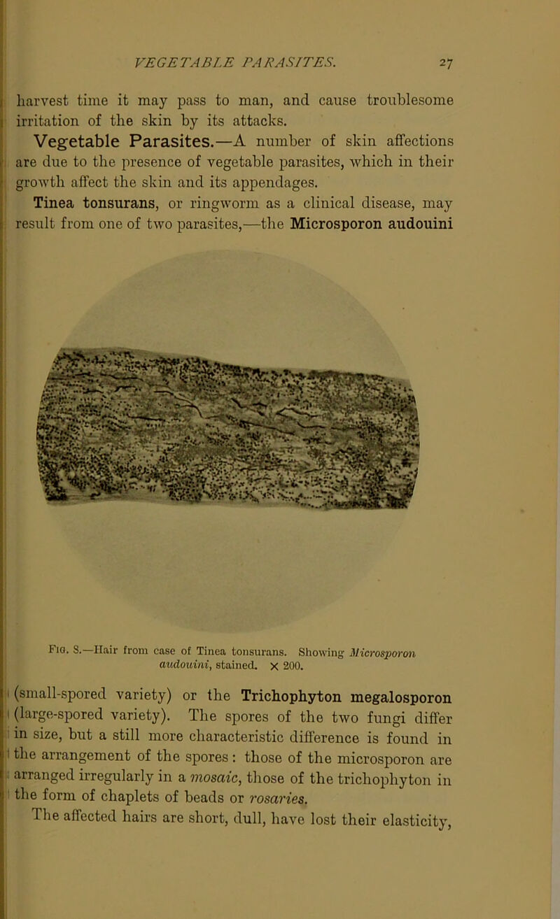 1 harvest time it may pass to man, and cause troublesome 1 irritation of the skin by its attacks. Vegetable Parasites.—A number of skin affections ' are due to the presence of vegetable parasites, which in their ! growth affect the skin and its appendages. Tinea tonsurans, or ringworm as a clinical disease, may result from one of two parasites,—the Microsporon audouini Fig. 8. Ilair from case of Tinea tonsurans. Showing Microsporon audouini, stained, x 200. (small-spored variety) or the Trichophyton megalosporon (large-spored variety). The spores of the two fungi differ in size, but a still more characteristic difference is found in * ^ie arrangement of the spores : those of the microsporon are arranged irregularly in a mosaic, those of the trichophyton in the form of chaplets of beads or rosaries. The affected hairs are short, dull, have lost their elasticity,