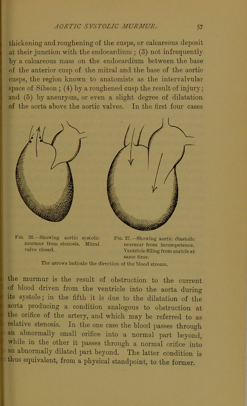 thickening and roughening of the cusps, or calcareous deposit at their junction with the endocardium ; (3) not infrequently by a calcareous mass on the endocardium between the base of the anterior cusp of the mitral and the base of the aortic cusps, the region known to anatomists as the intervalvular space of Sibson ; (4) by a roughened cusp the result of injury; and (5) by aneurysm, or even a slight degree of dilatation of the aorta above the aortic valves. In the first four cases Fio. 26. Showing aortic systolic Fig. 27.—Showing aortic diastolic murmur from stenosis. Mitral murmur from incompetence, valve closed. Ventricle filli ng from auricle at same time. The arrows indicate the direction of the blood stream. the murmur is the result of obstruction to the current of blood driven from the ventricle into the aorta durin ; its systole; in the fifth it is due to the dilatation of the aorta producing a condition analogous to obstruction at the orifice of the artery, and which may be referred to as relative stenosis. In the one case the blood passes through an abnormally small orifice into a normal part beyond, while in the other it passes through a normal orifice into an abnormally dilated part beyond. The latter condition is thus equivalent, from a physical standpoint, to the former.