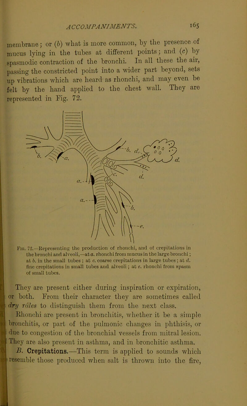membrane; or (b) what is more common, by the presence of mucus lying in the tubes at different points; and (c) by spasmodic contraction of the bronchi. In all these the air, passing the constricted point into a wider part beyond, sets up vibrations which are heard as rlionchi, and may even be felt by the hand applied to the chest wall, they are represented in Fig. 72. Fig. 72.—Representing the production of rhonohi, and of crepitations in the bronchi and alveoli,—at a. rhonohi from mucus in the large bronchi; at b. in the small tubes ; at c. coarse crepitations in large tubes ; at d. fine crepitations in small tubes and alveoli; at e. rhonohi from spasm of small tubes. They are present either during inspiration or expiration, or both. From their character they are sometimes called dry rules to distinguish them from the next class. Khonchi are present in bronchitis, whether it be a simple bronchitis, or part of the pulmonic changes in phthisis, or due to congestion of the bronchial vessels from mitral lesion. 1 They are also present in asthma, and in bronchitic asthma. B. Crepitations.—This term is applied to sounds which resemble those produced when salt is thrown into the fire,