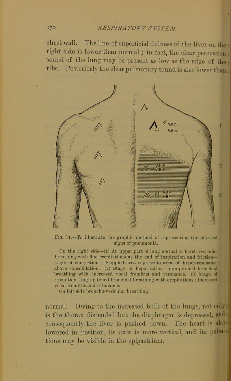 chest wall. The line of superficial dulness of the liver on the right side is lower than normal; in fact, the clear percussion sound of the lung may be present as low as the edge of the - ribs. Posteriorly the clear pulmonary sound is also lower than 1 2 -3 Fig. 74.—To illustrate the graphic method of representing the physical signs of pneumonia. On the right side—(1) At upper part of lung normal or harsh vesicular breathing with fine crepitations at the end of inspiration and friction- stage of congestion. Stippled area represents area of hyper-resonance above consolidation. (2) Stage of hepatisation—high-pitched bronchial breathing with increased vocal fremitus and resonance. (3) Stage of resolution—high-pitched bronchial breathing with crepitations ; increased vocal fremitus and resonance. On left side broncho-vesicular breathing. normal. Owing to the increased hulk of the lungs, not only is the thorax distended but the diaphragm is depressed, ami consequently the liver is pushed down. The heart is also- lowered in position, its axis is more vertical, and its pulsa- tions may he visible in the epigastrium.