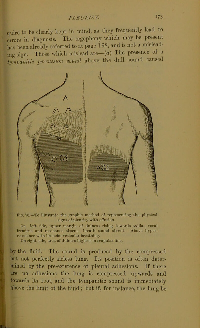 quire to be clearly kept in mind, as they frequently lead to errors in diagnosis. The oegophony which may be present has been already referred to at page 168, and is not a mislead- ing sign. Those which mislead are—(a) The presence of a tympanitic percussion sound above the dull sound caused F10. 76.—To illustrate the graphic method of representing the physical signs of pleurisy with effusion. On left side, upper margin of dulness rising towards axilla; vocal fremitus and resonance absent; breath sound absent. Above hyper- resonance with broncho-vesicular breathing. On right side, area of dulness highest in scapular line. by the fluid. The sound is produced by the compressed but not perfectly airless lung. Its position is often deter- mined by the pre-existence of pleural adhesions. If there are no adhesions the lung is compressed upwards and towards its root, and the tympanitic sound is immediately above the limit of the fluid; but if, for instance, the lung be