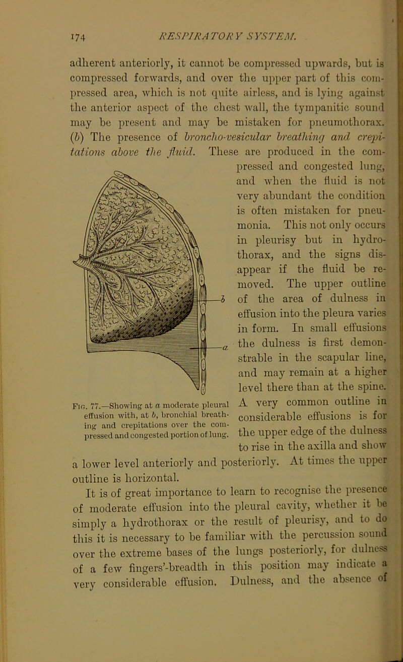 adherent anteriorly, it cannot be compressed upwards, but is compressed forwards, and over the upper part of this com- pressed area, which is not quite airless, and is lying against the anterior aspect of the chest wall, the tympanitic sound may be present and may he mistaken for pneumothorax. (b) The presence of broncho-vesicular breathing and crepi- tations above the fluid. These are produced in the com- pressed and congested lung, and when the fluid is not very abundant the condition is often mistaken for pneu- monia. This not only occurs in pleurisy hut in hydro- thorax, and the signs dis- appear if the fluid be re- moved. The upper outline of the area of dulness in effusion into the pleura varies in form. In small effusions the dulness is first demon- strable in the scapular line, and may remain at a higher level there than at the spine. A very common outline in considerable effusions is for the upper edge of the dulness to rise in the axilla and show Fig. 77.—Showing at a moderate pleural effusion with, at 6, bronchial breath- ing and crepitations over the com- pressed and congested portion of lung. a lower level anteriorly and posteriorly. At times the upper outline is horizontal. It is of great importance to learn to recognise the presence of moderate effusion into the pleural cavity, whether it be simply a hydrothorax or the result of pleurisy, and to do this it is necessary to be familiar with the percussion sound over the extreme bases of the lungs posteriorly, for dulness of a few fingers’-breadth in this position may indicate a very considerable effusion, Dulness, and the absence of