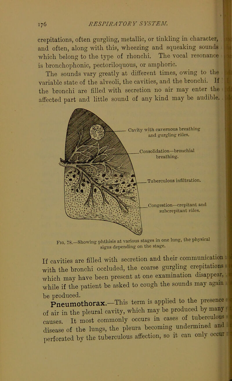 crepitations, often gurgling, metallic, or tinkling in character, and often, along with this, wheezing and squeaking sounds which belong to the type of rhonchi. The vocal resonance is bronchophonic, pectoriloquous, or amphoric. The sounds vary greatly at dilferent times, owing to the variable state of the alveoli, the cavities, and the bronchi. If the bronchi are filled with secretion no air may enter the affected part and little sound of any kind may be audible. Cavity with cavernous breathing and gurgling rales. Consolidation—bronchial breathing. Tuberculous infiltration. Congestion—crepitant and subcrepitant rales. Fio. 78.—Showing phthisis at various stages in one lung, the physical signs depending on the stage. If cavities are filled with secretion and their communication I with the bronchi occluded, the coarse gurgling crepitations - which may have been present at one examination disappear, while if the patient be asked to cough the sounds may again be produced. 1 Pneumothorax.-This term is applied to the presence I of air in the pleural cavity, which may be produced by many n causes. It most commonly occurs in cases of tuberculous disease of the lungs, the pleura becoming undermined and perforated by the tuberculous affection, so it can only occur