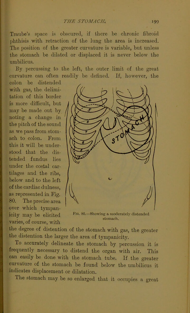 Traube’s space is obscured, if there be chronic fibroid phthisis with retraction of the lung the area is increased. The position of the greater curvature is variable, but unless the stomach be dilated or displaced it is never below the umbilicus. By percussing to the left, the outer limit of the great curvature can often readily be defined. If, however, the colon be distended with gas, the delimi- tation of this border is more difficult, but may be made out by noting a change in the pitch of the sound as we pass from stom- ach to colon. From this it will be under- stood that the dis- tended fundus lies under the costal car- tilages and the ribs, below and to the left of the cardiac dulness, as represented in Fig. 80. The precise area over which tympan- icity may be elicited varies, of course, with Fig. 80.—Showing a moderately distended stomach. the degree of distention of the stomach with gas, the greater the distention the larger the area of tympanicity. To accurately delineate the stomach by percussion it is frequently necessary to distend the organ with air. This can easily be done with the stomach tube. If the greater curvature of the stomach be found below the umbilicus it indicates displacement or dilatation. The stomach may be so enlarged that it occupies a great