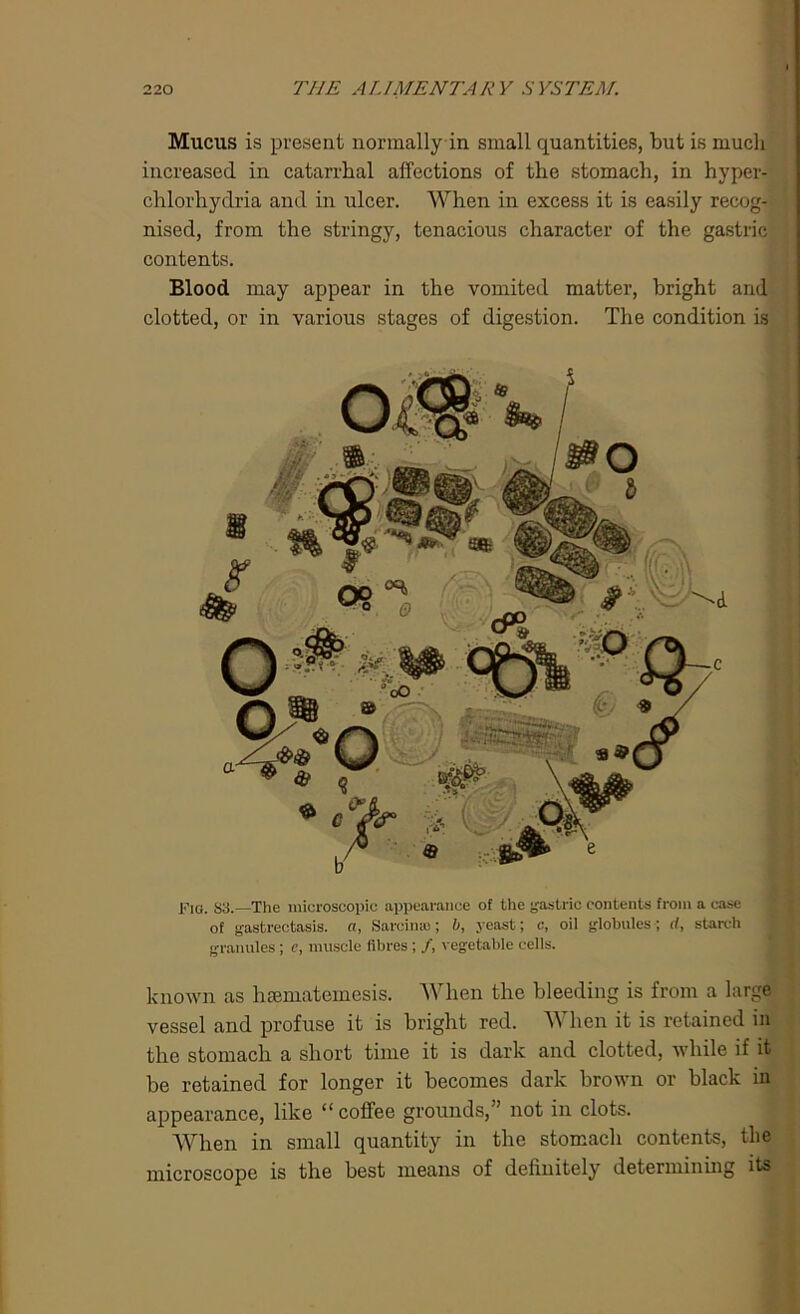 Mucus is present normally in small quantities, but is much increased in catarrhal affections of the stomach, in hyper- chlorhydria and in ulcer. When in excess it is easily recog- nised, from the stringy, tenacious character of the gastric contents. Blood may appear in the vomited matter, bright and clotted, or in various stages of digestion. The condition is Fig. S3.—The microscopic appearance of the gastric contents from a case of gastrectasis. a, Sarcime; b, yeast; c, oil globules; rf, starch granules; c, muscle fibres; /, vegetable cells. known as hmmatemesis. When the bleeding is from a large vessel and profuse it is bright red. When it is retained in the stomach a short time it is dark and clotted, while if it be retained for longer it becomes dark brown or black in appearance, like “coffee grounds,” not in clots. When in small quantity in the stomach contents, the microscope is the best means of definitely determining its
