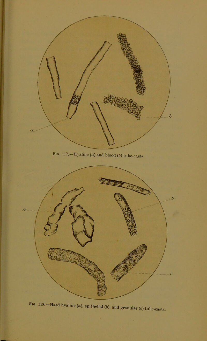 H'io 117.—Hyaline (a) and blood (b) tube-oasts