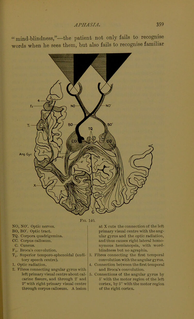 “ mind-blindness,”—the patient not only fails to recognise words when he sees them, hut also fails to recognise familiar NO, NO'. Optic nerves. BO, BO'. Optic tract. TQ. Corpora quadrigemina. CC. Corpus callosum. C. Cuneus. F.,. Broca’s convolution. T,. Superior temporo-sphenoidal (audi- tory speech centre). 1. Optic radiation. 2. Fibres connecting angular gyrus with left primary visual centre about cal- carine fissure, and through 2' and 2 with right primary visual centre through corpus callosum. A lesion at X cuts the connection of the left primary visual centre with the ang- ular gyrus and the optic radiation, and thus causes right lateral homo- nymous hemianopsia, with word- blindness but no agraphia. 3. Fibres connecting the first temporal convolution with the angular gyrus. 4. Connection between the first temporal and Broca’s convolution. 5. Connections of the angular gyrus by 5' with the motor region of the left cortex, by 5 with the motor region of the right cortex.
