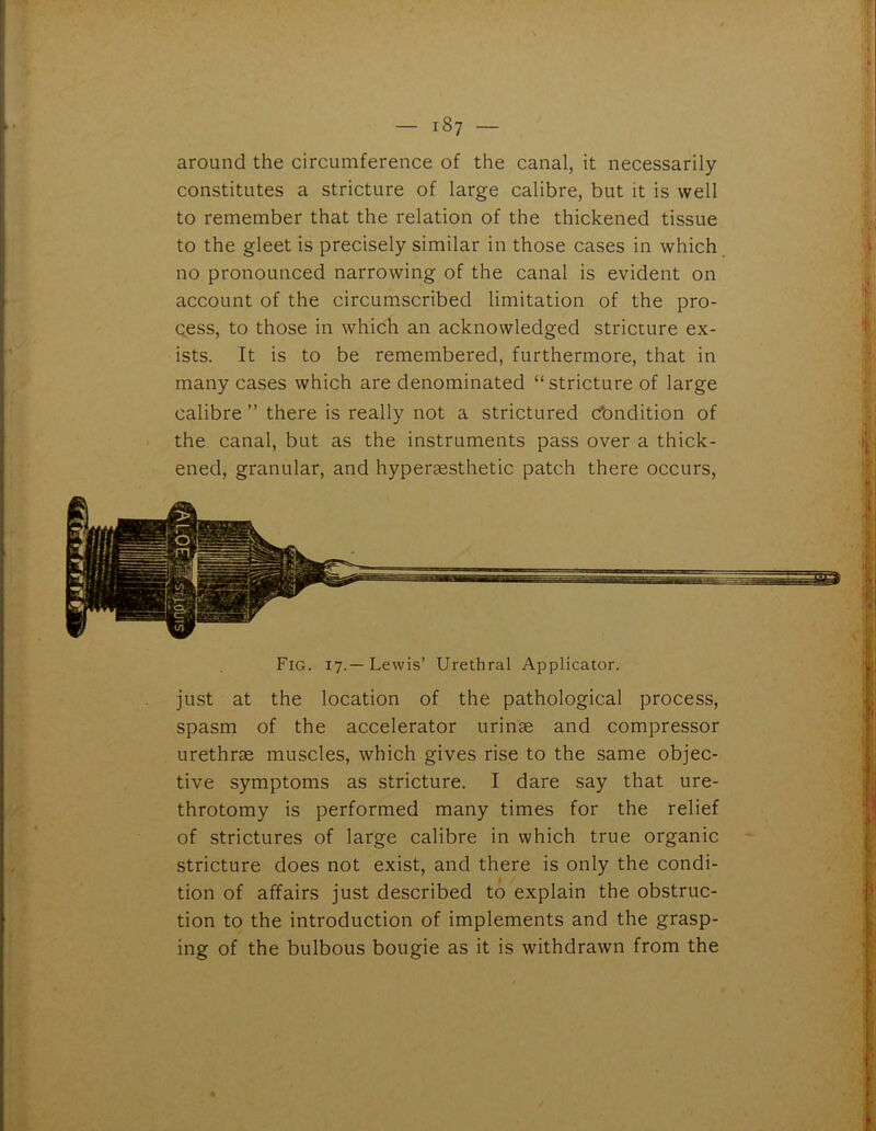 around the circumference of the canal, it necessarily constitutes a stricture of large calibre, but it is well to remember that the relation of the thickened tissue to the gleet is precisely similar in those cases in which no pronounced narrowing of the canal is evident on account of the circumscribed limitation of the pro- cess, to those in which an acknowledged stricture ex- ists. It is to be remembered, furthermore, that in many cases which are denominated “stricture of large calibre ” there is really not a strictured condition of the canal, but as the instruments pass over a thick- ened, granular, and hypergesthetic patch there occurs, Fig. 17.—Lewis’ Urethral Applicator. just at the location of the pathological process, spasm of the accelerator urinae and compressor urethrae muscles, which gives rise to the same objec- tive symptoms as stricture. I dare say that ure- throtomy is performed many times for the relief of strictures of large calibre in which true organic stricture does not exist, and there is only the condi- tion of affairs just described to explain the obstruc- tion to the introduction of implements and the grasp- ing of the bulbous bougie as it is withdrawn from the *