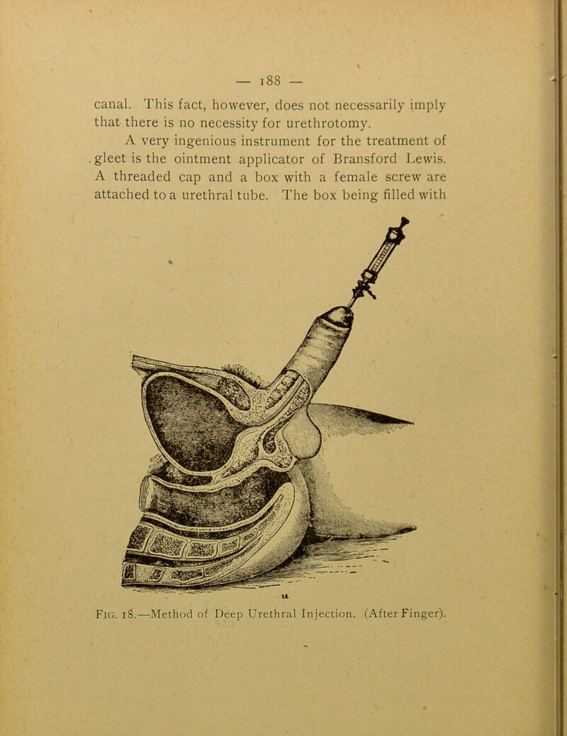 canal. This fact, however, does not necessarily imply that there is no necessity for urethrotomy. A very ingenious instrument for the treatment of gleet is the ointment applicator of Bransford Lewis. A threaded cap and a box with a female screw are attached to a urethral tube. The box being filled with Fig. 18.—Method of Deep Urethral Injection. (After Finger).
