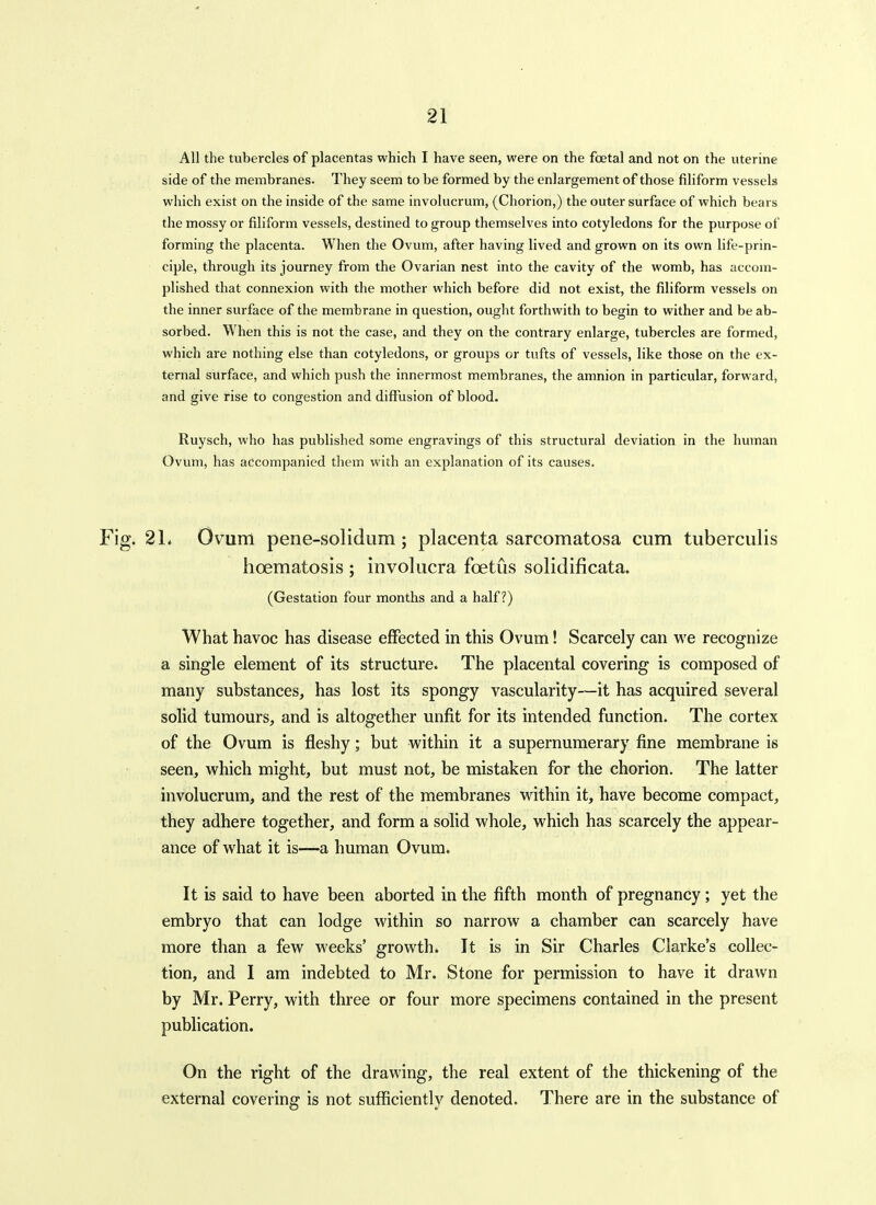 All the tubercles of placentas which I have seen, were on the foetal and not on the uterine side of the membranes. They seem to be formed by the enlargement of those filiform vessels which exist on the inside of the same involucrum, (Chorion,) the outer surface of which bears the mossy or filiform vessels, destined to group themselves into cotyledons for the purpose of forming the placenta. When the Ovum, after having lived and grown on its own life-prin- ciple, through its journey from the Ovarian nest into the cavity of the womb, has accom- plished that connexion with the mother which before did not exist, the filiform vessels on the inner surface of the membrane in question, ought forthwith to begin to wither and be ab- sorbed. When this is not the case, and they on the contrary enlarge, tubercles are formed, which are nothing else than cotyledons, or groups or tufts of vessels, like those on the ex- ternal surface, and which push the innermost membranes, the amnion in particular, forward, and give rise to congestion and diffusion of blood. Ruysch, who has published some engravings of this structural deviation in the human Ovum, has accompanied them with an explanation of its causes. 21. Ovum pene-solidum; placenta sarcomatosa cum tuberculis hoematosis ; involucra foetus solidificata. (Gestation four months and a half?) What havoc has disease effected in this Ovum! Scarcely can v^'e recognize a single element of its structure. The placental covering is composed of many substances, has lost its spongy vascularity—it has acquired several solid tumours, and is altogether unfit for its intended function. The cortex of the Ovum is fleshy; but within it a supernumerary fine membrane is seen, which might, but must not, be mistaken for the chorion. The latter involucrum, and the rest of the membranes within it, have become compact, they adhere together, and form a solid whole, which has scarcely the appear- ance of what it is—a human Ovum. It is said to have been aborted in the fifth month of pregnancy; yet the embryo that can lodge within so narrow a chamber can scarcely have more than a few weeks' growth. It is in Sir Charles Clarke's collec- tion, and I am indebted to Mr. Stone for permission to have it drawn by Mr. Perry, with three or four more specimens contained in the present publication. On the right of the drawing, the real extent of the thickening of the external covering is not sufficiently denoted. There are in the substance of