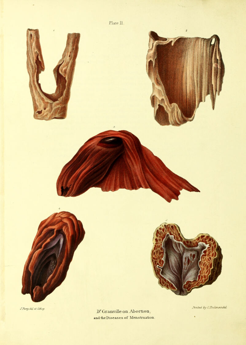 4 Graimlle on Ab ortLOU^ andtLeDiseases of MenstruatioiL. *