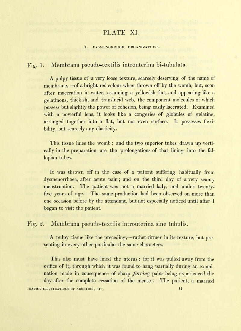 A. DYSMENORRHOIC ORGANIZATIONS. Fig. 1. Membrana pseudo-textilis introuterina bi-tubiilata. A pulpy tissue of a very loose texture, scarcely deserving of the name of membrane,—of a bright red colour when thrown off by the womb, but, soon after maceration in water, assuming a yellowish tint, and appearing like a gelatinous, thickish, and translucid web, the component molecules of which possess but slightly the power of cohesion, being easily lacerated. Examined with a powerful lens, it looks like a congeries of globules of gelatine, arranged together into a flat, but not even surface. It possesses flexi- bility, but scarcely any elasticity. This tissue lines the womb; and the two superior tubes drawn up verti- cally in the preparation are the prolongations of that lining into the fal- lopian tubes. It was thrown off in the case of a patient suffering habitually from dysmenorrhoea, after acute pain; and on the third day of a very scanty menstruation. The patient was not a married lady, and under twenty- five years of age. The same production had been observed on more than one occasion before by the attendant, but not especially noticed until after I began to visit the patient. Fig. 2. Membrana pseudo-textilis introuterina sine tubulis. A pulpy tissue like the preceding,—rather firmer in its texture, but pre- senting in every other particular the same characters. This also must have lined the uterus; for it was pulled away from the orifice of it, through which it was found to hang partially during an exami- nation made in consequence of sharp forcing pains being experienced the day after the complete cessation of the menses. The patient, a married ORAPHIC ILLUSTRATIONS OF ABORTION, ETC. G