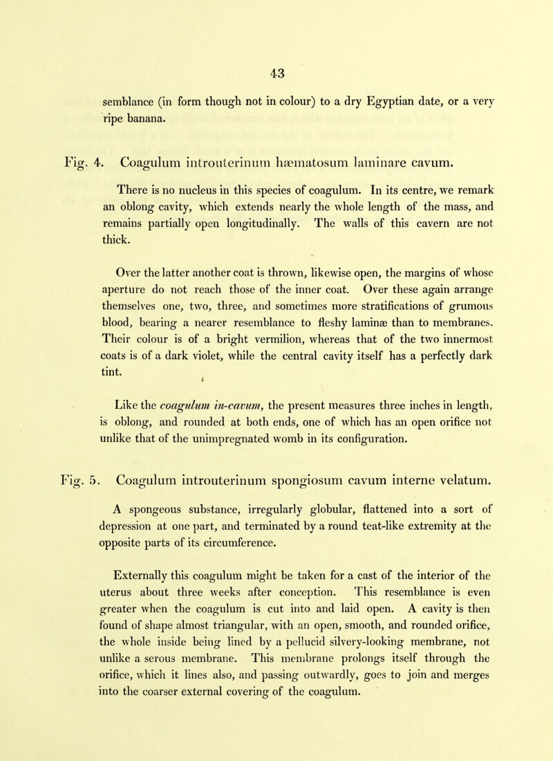 semblance (in form though not in colour) to a dry Egyptian date, or a very ripe banana. . 4. Coagulum introiiterinum haematosum laminare cavum. There is no nucleus in this species of coagulum. In its centre, we remark an oblong cavity, which extends nearly the whole length of the mass, and remains partially open longitudinally. The walls of this cavern are not thick. Over the latter another coat is thrown, hkewise open, the margins of whose aperture do not reach those of the inner coat. Over these again arrange themselves one, two, three, and sometimes more stratifications of grumous blood, bearing a nearer resemblance to fleshy laminae than to membranes. Their colour is of a bright vermilion, whereas that of the two innermost coats is of a dark violet, while the central cavity itself has a perfectly dark tint. Like the coagulum in-camm, the present measures three inches in length, is oblong, and rounded at both ends, one of which has an open orifice not unlike that of the unimpregnated womb in its configuration. 5. Coagulum introuterinum spongiosum cavum interne velatum. A spongeous substance, irregularly globular, flattened into a sort of depression at one part, and terminated by a round teat-like extremity at the opposite parts of its circumference. Externally this coagulum might be taken for a cast of the interior of the uterus about three weeks after conception. This resemblance is even greater when the coagulum is cut into and laid open. A cavity is then found of shape almost triangular, with an open, smooth, and rounded orifice, the whole inside being lined by a pellucid silvery-looking membrane, not unlike a serous membrane. This membrane prolongs itself through the orifice, which it lines also, and passing outwardly, goes to join and merges into the coarser external covering of the coagulum.