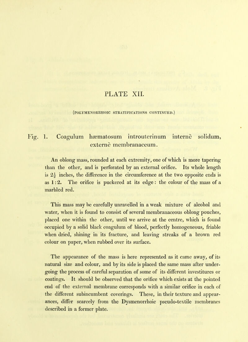 PLATE XII. (folymenorrhoic stratifications continued.) 1. Coagulum haematosum introuterinum interne solidum, externe membranaceum. An oblong mass, rounded at each extremity, one of which is more tapering than the other, and is perforated by an external orifice. Its whole length is 2^ inches, the difference in the circumference at the two opposite ends is as 1:2. The orifice is puckered at its edge : the colour of the mass of a marbled red. This mass may be carefully unravelled in a weak mixture of alcohol and water, when it is found to consist of several membranaceous oblong pouches, placed one within the other, until we arrive at the centre, which is found occupied by a solid black coagulum of blood, perfectly homogeneous, friable when dried, shining in its fracture, and leaving streaks of a brown red colour on paper, when rubbed over its surface. The appearance of the mass is here represented as it came away, of its natural size and colour, and by its side is placed the same mass after under- going the process of careful separation of some of its different investitures or coatings. It should be observed that the orifice which exists at the pointed end of the external membrane corresponds with a similar orifice in each of the different subincumbent coverings. These, in their texture and appear- ances, differ scarcely from the Dysmenorrhoic pseudo-textile membranes described in a former plate.