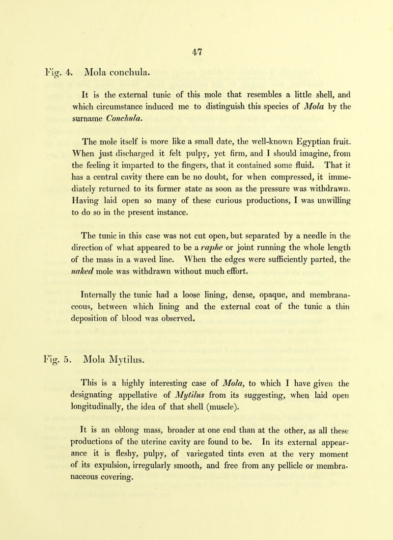 4. Mola conchula. It is the external tunic of this mole that resembles a little shell, and which circumstance induced me to distinguish this species of Mola by the surname Conchula, The mole itself is more hke a small date, the well-known Egyptian fruit. When just discharged it felt pulpy, yet firm, and I should imagine, from the feeling it imparted to the fingers, that it contained some fluid. That it has a central cavity there can be no doubt, for when compressed, it imme- diately returned to its former state as soon as the pressure was withdrawn. Having laid open so many of these curious productions, I was unwilling to do so in the present instance. The tunic in this case was not cut open, but separated by a needle in the direction of what appeared to be a raphe or joint running the whole length of the mass in a waved line. When the edges were sufficiently parted, the nahed mole was withdrawn without much effort. Internally the tunic had a loose lining, dense, opaque, and membrana- ceous, between which lining and the external coat of the tunic a thin deposition of blood was observed. 5. Mola Mvtilus. This is a highly interesting case of Mola, to which I have given the designating appellative of Mytilus from its suggesting, when laid open longitudinally, the idea of that shell (muscle). It is an oblong mass, broader at one end than at the other, as all these productions of the uterine cavity are found to be. In its external appear- ance it is fleshy, pulpy, of variegated tints even at the very moment of its expulsion, irregularly smooth, and free from any pellicle or membra- naceous covering.
