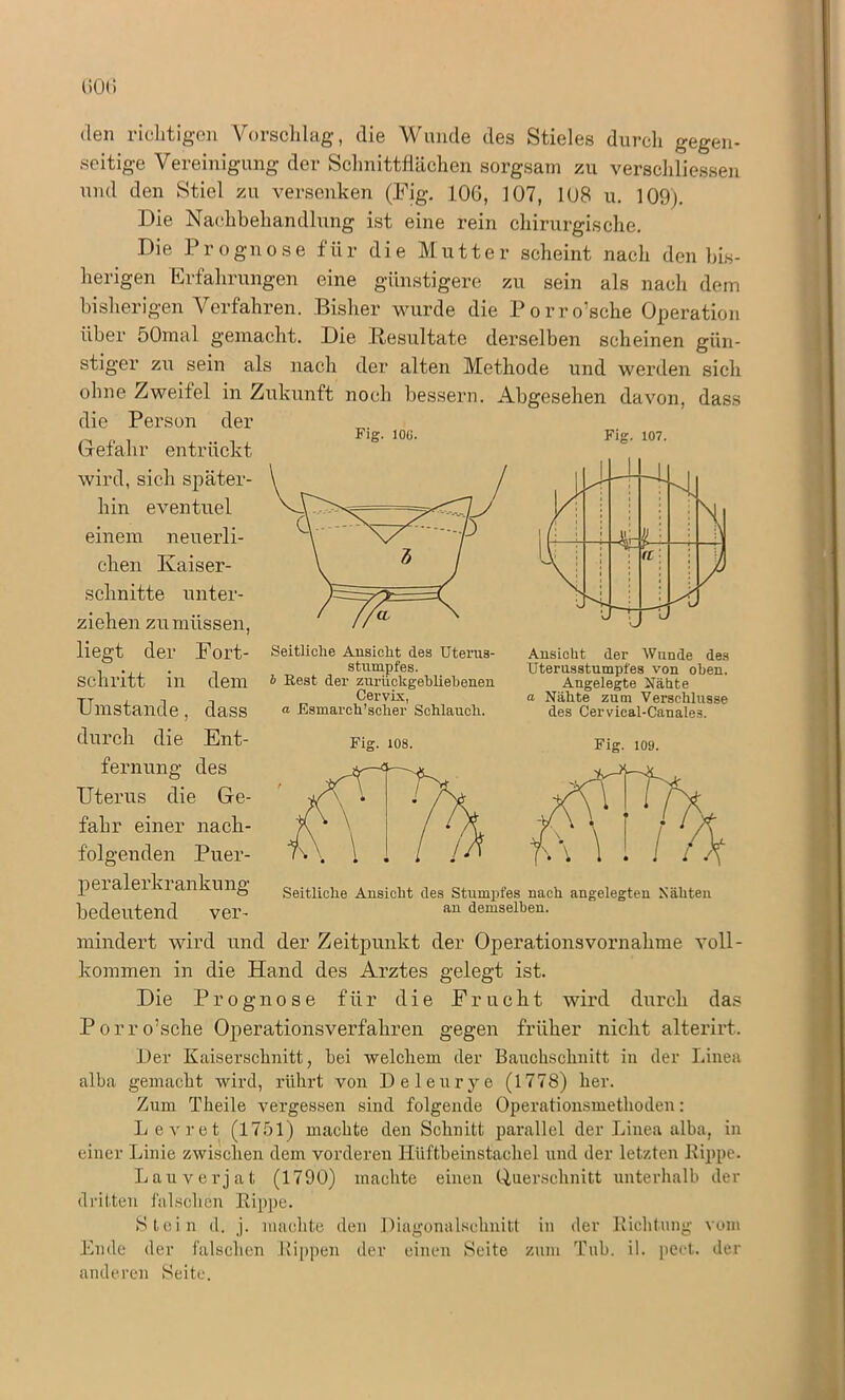 OCHi den richtigen Vorschlag, die Wunde des Stieles durch gegen- seitige Vereinigung der Schnittflächen sorgsam zu verschliessen und den Stiel zu versenken (Fig. 106, 107, 108 u. 109). Die Nachbehandlung ist eine rein chirurgische. Die Prognose für die Mutter scheint nach den bis- herigen Erfahrungen eine günstigere zu sein als nach dem bisherigen Verfahren. Bisher wurde die Porro’sche Operation über 50mal gemacht. Die Resultate derselben scheinen gün- stiger zu sein als nach der alten Methode und werden sich Fig. 107. Seitliche Ansicht des Uterus- stmnpfes. b Rest der zurückgebliebenen Cervix, a Esmarch’scher Schlauch. Fig. 108. Ansicht der Wunde des Uterusstumpfes von oben. Angelegte Nähte a Nähte zum Verschlüsse des Cervieal-Canale3. ohne Zweifel in Zukunft noch bessern. Abgesehen davon, dass die Person der Fig. 100. Gefahr entrückt wird, sich später- hin eventuel einem neuerli- chen Kaiser- schnitte unter- ziehen zu müssen, liegt der Fort- schritt in dem Umstande, dass durch die Ent- fernung des Uterus die Ge- fahr einer nach- folgenden Puer- peralerkrankung bedeutend ver- mindert wird und der Zeitpunkt der Operationsvornahme voll- kommen in die Hand des Arztes gelegt ist. Die Prognose für die Frucht wird durch das Porro’sche Operationsverfahren gegen früher nicht alterirt. Der Kaiserschnitt, hei welchem der Bauchschnitt in der Linea alba gemacht wird, rührt von Deleurye (1778) her. Zum Theile vergessen sind folgende Operationsmethoden: Levret (17hl) machte den Schnitt parallel der Linea alba, in einer Linie zwischen dem vorderen Ilüftbeinstachel und der letzten Kippe. Lauverjat (1790) machte einen Querschnitt unterhalb der dritten falschen Kippe. Stein d. j. machte den Diagonalschnitt in der Richtung vom Ende der falschen Kippen der einen Seite zum Tub. il. pect, der anderen Seite. Seitliche Ansicht des Stumpfes nach angelegten Nähten an demselben.