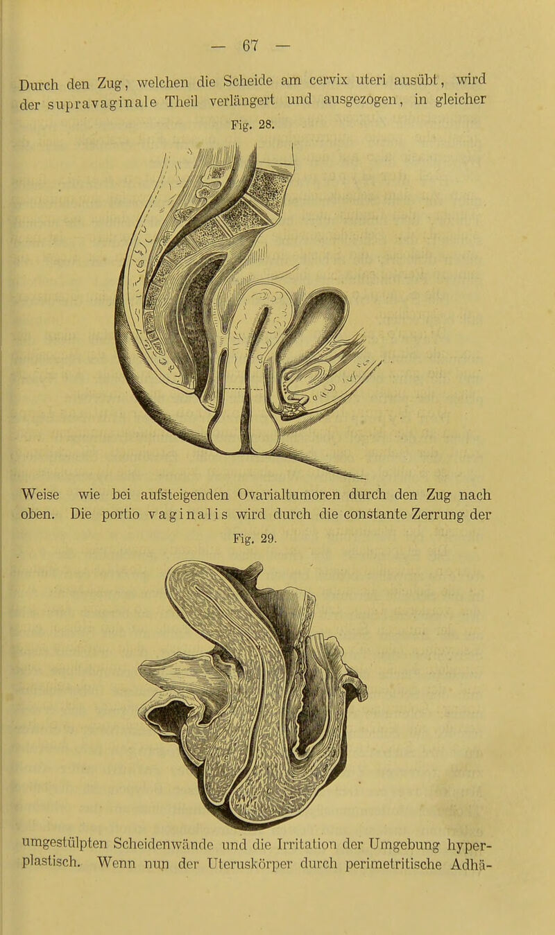 Durch den Zug, welchen die Scheide am cervix uteri ausübt, wird der supravaginale Tlieil verlängert und ausgezogen, in gleicher Fig. 28. Weise wie bei aufsteigenden Ovarialtumoren durch den Zug nach oben. Die portio vaginalis wird durch die constante Zerrung der Fig. 29. umgestülpten Scheidonwände und die Irritation der Umgebung hyper- plastisch. Wenn nun der Uteruskörper durch perimetritische Adhä-