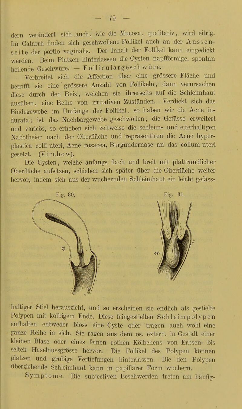dern verändert sich auch, wie die Mucosa, qualitativ, wird eitrig. Im Catarrh finden sich geschwollene Follikel auch an der Aussen- seite der portio vaginalis. Der Inhalt der Follikel kann eingedickt werden. Beim Platzen hinterlassen die Cysten napfförmige, spontan heilende Geschwüre. — Folliculargeschwüre. Verbreitet sich die Affection über eine grössere Fläche und betrifft sie eine' grössere Anzahl von Follikeln, dann verursachen diese durch den Reiz, welchen sie ihrerseits auf die Schleimhaut ausüben, eine Reihe von irritativen Zuständen. Verdickt sich das Bindegewebe im Umfange der Follikel, so haben wir die Acne in- durata; ist das Nachbargewebe geschwollen, die Gefässe erweitert und varicös, so erheben sich zeitweise die schleim- und eiterhaltigen Nabotheier nach der Oberfläche und repräsentiren die Acne hyper- plastica colli uteri, Acne rosacea, Burgundernase an das coUum uteri gesetzt. (Virchow). Die Cysten, welche anfangs flach und breit mit plattrundlicher Oberfläche aufsitzen, schieben sich später über die Oberfläche weiter hervor, indem sich aus der wuchernden Schleimhaut ein leicht gefäss- Fig. 30. Fig. 31. haltiger Stiel herauszieht, und so erscheinen sie endlich als gestielte Polypen mit kolbigem Ende. Diese feingestielten Schleimpolypen enthalten entweder bloss eine Cyste oder tragen auch wohl eine ganze Reihe in sich. Sie ragen aus dem os. extern, in Gestalt einer kleinen Blase oder eines feinen rothen Kölbchens von Erbsen- bis selten Haselnussgrösse hervor. Die Follikel des Polypen können platzen und grubige Vertiefungen hinterlassen. Die den Polypen überziehende Schleimhaut kann in papillärer Form -wuchern. Symptome. Die subjectiven Beschwerden treten am häufig-