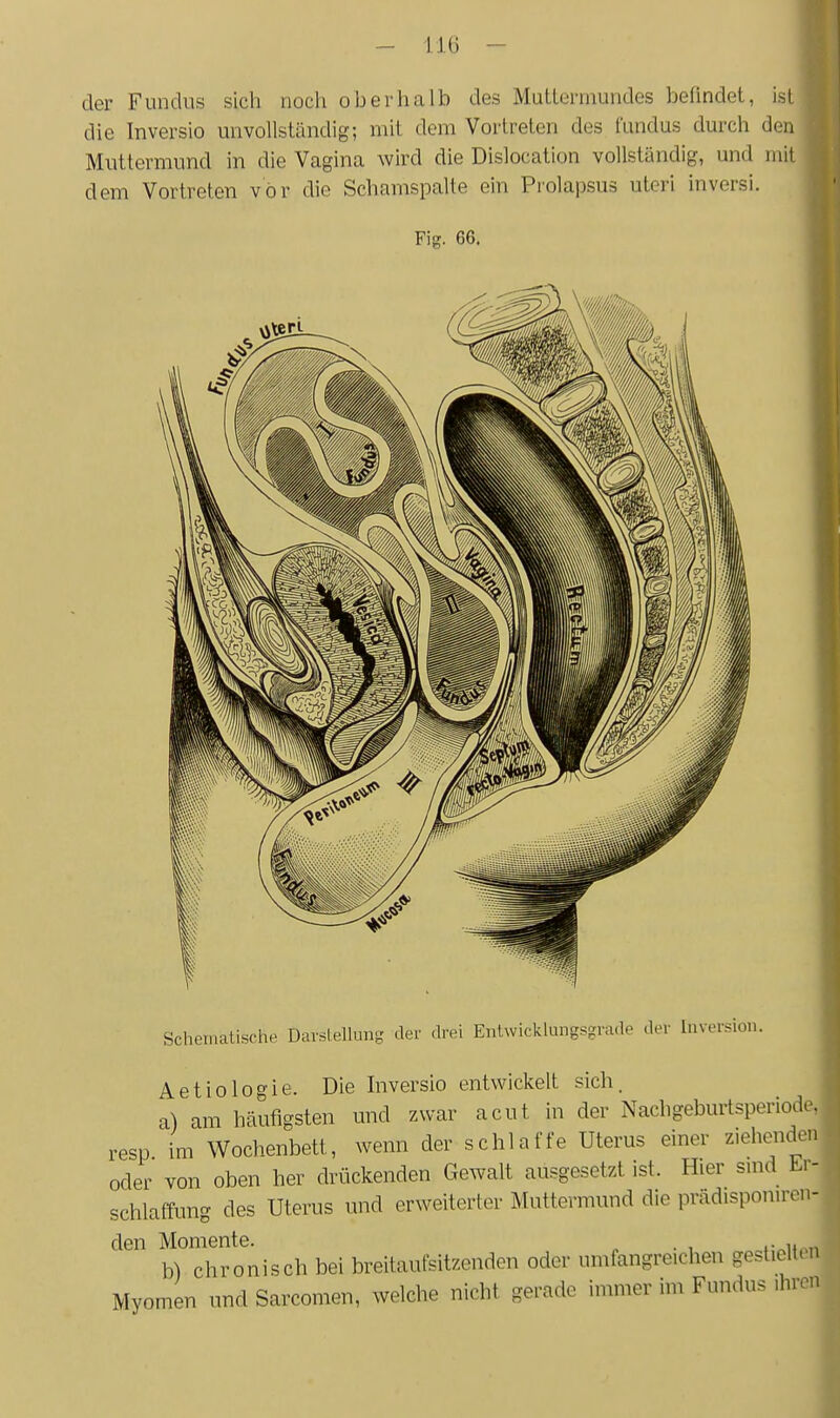 - liü - der Fundus sich noch oberhalb des Mutlerniundes befindet, ist die Inversio unvollständig; mit dem Vortreten des fundus durch den Muttermund in die Vagina wird die Dislocation vollständig, und mit dem Vortreten vor die Schamspalte ein Prolapsus uteri inversi. Fig. 66. Schematische Darstellung der drei Entwicklungsgrade der Inversion. Aetiologie. AtLiuiugi.. Die Inversio entwickelt sich. a) am häufigsten und zwar acut in der Nachgeburtsperiodc. resp im Wochenbett, wenn der schlaffe Uterus einer ziehenden oder von oben her drückenden Gewalt ausgesetzt ist. Hier smd Er- schlaffung des Uterus und erweiterter Muttermund die prcädisponiren- den Momente. ^ . , ,. „ b) chronisch bei breitaufsitzenden oder umfangreichen gestielten Myomen und Sarcomen, welche nicht gerade immer im Fundus ihren