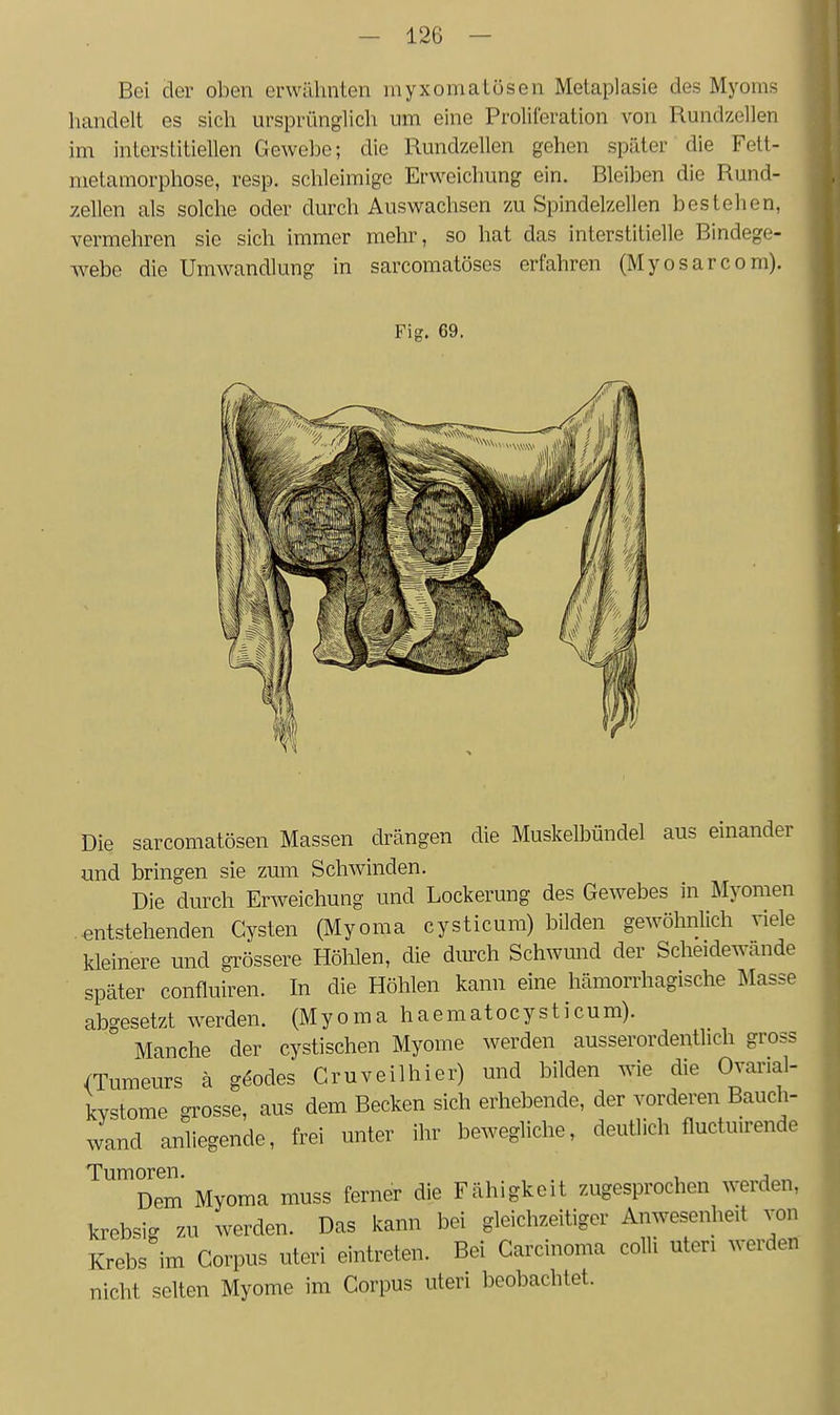 Bei der oben erwähnten myxomalösen Metaplasie des Myoms handelt es sich ursprünglich um eine Proliferation von Rundzellen im interstitiellen Gewebe; die Rundzellen gehen später die Fett- nietamorphose, resp. schleimige Erweichung ein. Bleiben die Rund- zellen als solche oder durch Auswachsen zu Spindelzellen bestehen, vermehren sie sich immer mehr, so hat das interstitielle Bindege- webe die Umwandlung in sarcomatöses erfahren (Myosarcom). Fig. 69. Die sarcomatösen Massen drängen die Muskelbündel aus einander und bringen sie zum Schwinden. Die durch Erweichung und Lockerung des Gewebes in Myomen entstehenden Cysten (Myoma cysticura) bilden gewöhnlich viele kleinere und grössere Höhlen, die diu-ch Schwund der Scheidewände später confluiren. In die Höhlen kann eine hämorrhagische Masse abgesetzt werden. (Myoma haematocysticum). Manche der cystischen Myome werden ausserordentlich gross /Tumeurs ä göocles Cruveilhier) und bilden wie die Ovarial- kvstome grosse, aus dem Becken sich erhebende, der vorderen Bauch- wand anliegende, frei unter ihr bewegliche, deutlich fluctuirende Tumoren. , •, , Dem Myoma muss ferner die Fähigkeit zugesprochen werden, krebsig zu werden. Das kann bei gleichzeitiger Anwesenheit von Krebs im Corpus uteri eintreten. Bei Carcinoma colli uteri werden nicht selten Myome im Corpus uteri beobachtet.