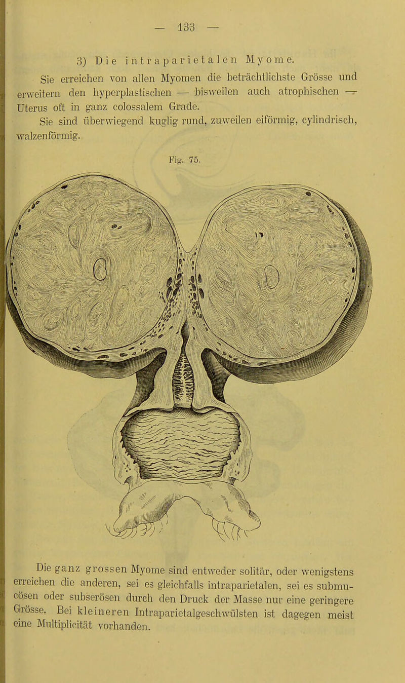 3) Die i n t r a p a r i c t a 1 c n Myome. Sie erreichen von allen Myomen die beträchllichste Grösse und erweitern den hyperplastischen — bisweilen auch atrophischen — Uterus oft in ganz colossalem Grade. Sie sind überwiegend kuglig rund, zuweilen eiförmig, cylindrisch, walzenförmig. Fi!^'. 75. Die ganz grossen Myome sind entweder solitär, oder wenigstens erreichen die anderen, sei es gleichfalls intraparietalen, sei es submu- cösen oder subserösen durch den Druck der Masse nur eine geringere Grösse. Bei kleineren Intraparietalgeschwülsten ist dagegen meist eine Multiplicität vorhanden.