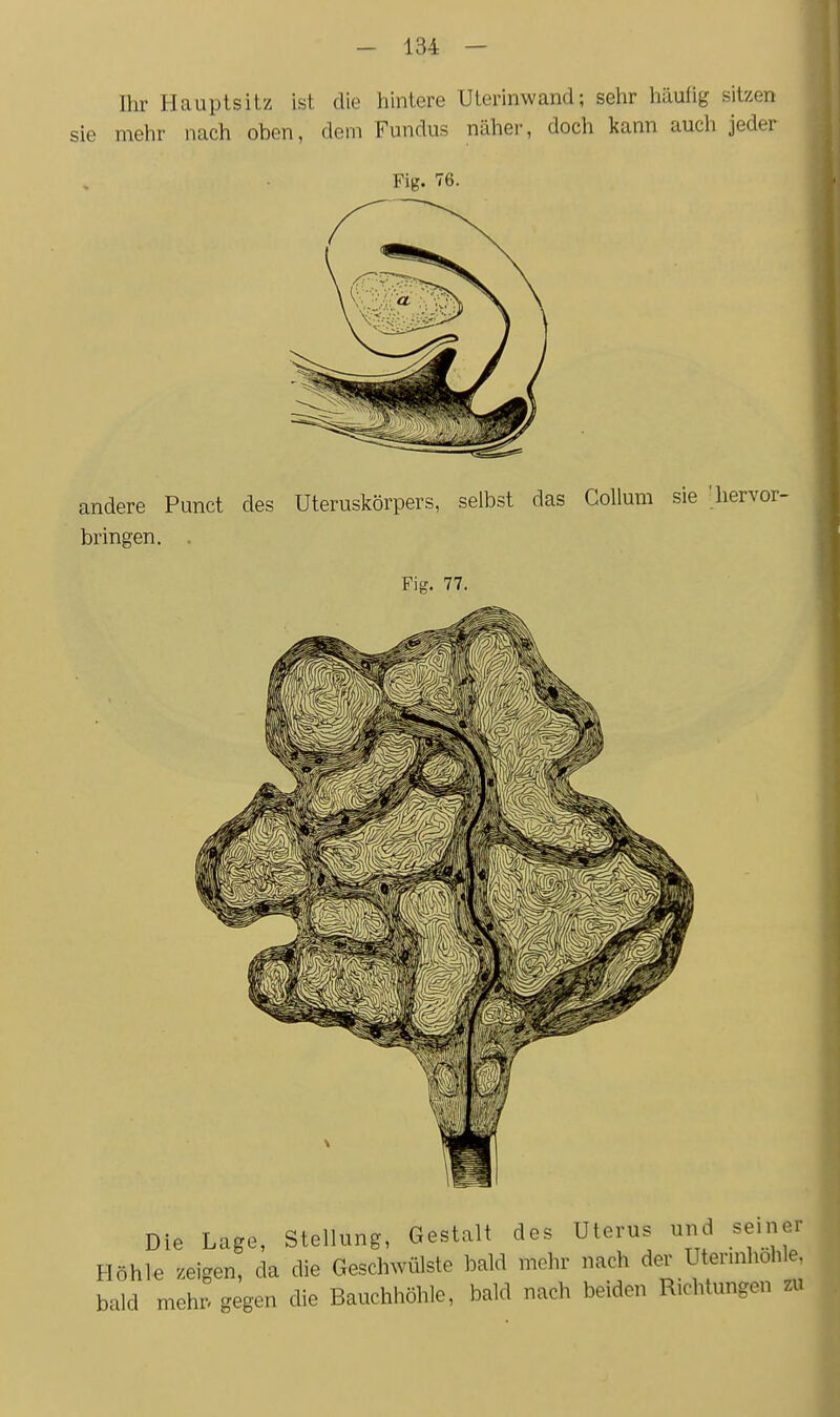 Ihr Hauptsitz ist die hintere Uterinwand; sehr liäulig sitzen sie melir nach oben, dem Fundus näher, doch kann auch jeder Fig. 76. andere Punct des üteruskörpers, selbst das Collum sie 'hervor- bringen. . Fig. 77. Die Lage, Stellung, Gestalt des Uterus und seiner Höhle zeigen, da die Geschwülste bald mehr nach der Uterinholile, bald mehr, gegen die Bauchhöhle, bald nach beiden Richtungen zu