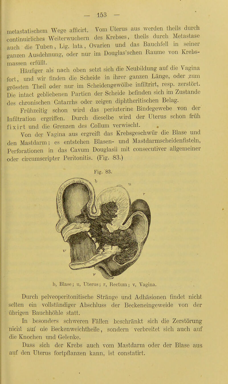 metastatischem Wege afficirt. Vom Uterus aus werden Iheils durch continuirliches Weiterwuchern des Krebses, theils durch Metastase auch die Tuben, Lig. lata, Ovarien und das Bauchfell in seiner ganzen Ausdehnung, oder nur im Douglas'schen Räume von Krebs- massen erfüllt. Häufiger als nach oben setzt sich die Neubildung auf die Vagina fort, und wir finden die Scheide in ihrer ganzen Länge, oder zum grös'sten Theil oder nur im Scheidengewölbe infiltrirt, resp. zerstört. Die intact gebliebenen Partien der Scheide befinden sich im Zustande des chronischen Catarrhs oder zeigen diphtheritischen Belag. Frühzeitig schon wird das periuterine Bindegewebe von der Infiltration ergriffen. Durch dieselbe wird der Uterus schon früh fixirt und die Grenzen des Collum verwischt. ^ Von der Vagina aus ergreift das Krebsgeschwür die Blase und den Mastdarm; es entstehen Blasen- und Mastdarmscheidenfisteln, Perforationen in das Cavum Douglasii mit consecutiver allgemeiner oder circumscripter Peritonitis. (Fig. 83.) Fig. '83. b, Blase; u, Uterus; r, Rectum; v, Vagina. Durch pelveoperitonitische Stränge und Adhäsionen findet nicht selten ein vollständiger Abschluss der Beckeneingeweide von der übrigen Bauchhöhle statt. In besonders schweren E'ällen bcscliränkt sich die Zerstörung nicht auf aie Beckenweichtheile, sondern verbreitet sich auch auf die Knochen und Gelenke. Dass sich der Krebs auch vom Mastdarm oder der Blase aus auf den Uterus fortpflanzen kann, ist constatirt.