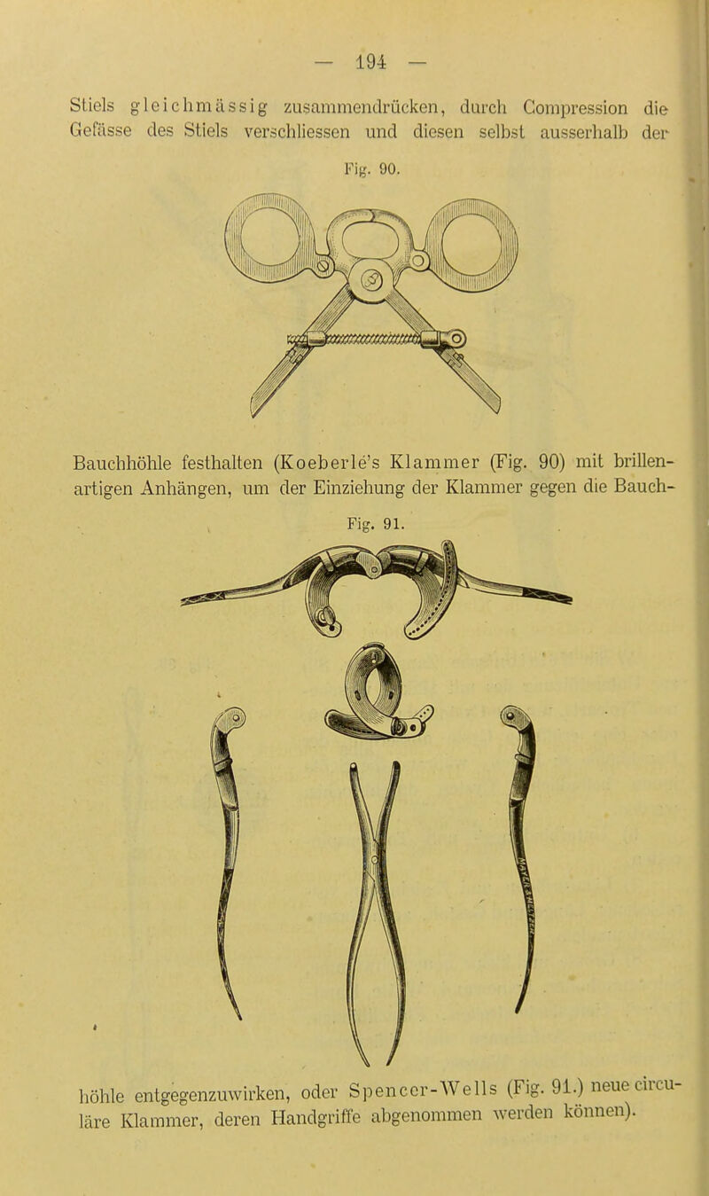 Stiels gleich massig zusammendrücken, durch Gompression die Gefässe des Stiels verschliessen und diesen selbst ausserhalb der Fit'. 90- Bauchhöhle festhalten (Koeberle's Klammer (Fig. 90) mit brillen- artigen Anhängen, um der Einziehung der Klammer gegen die Bauch- Fig. 91. höhle entgegenzuwirken, oder Spencer-AVells (Fig. 91.) neue( läre Klammer, deren Handgriffe abgenommen werden können).