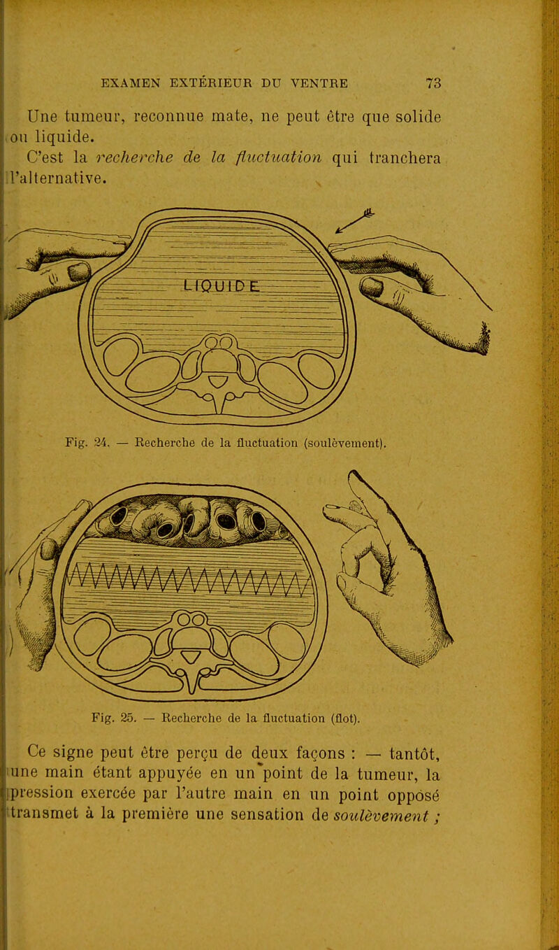 Une tumeur, reconnue mate, ne peut être que solide >ou liquide. C'est la recherche de la fiiictuation qui tranchera l'alternative. Fig. 24. — Recherche de la fluctuation (soulèvement). Fig. 25. — Recherche de la fluctuation (flot). Ce signe peut être perçu de deux façons : — tantôt, mne main étant appuyée en un^point de la tumeur, la ipression exercée par l'autre main en un point opposé (transmet à la première une sensation de soulèvement ;