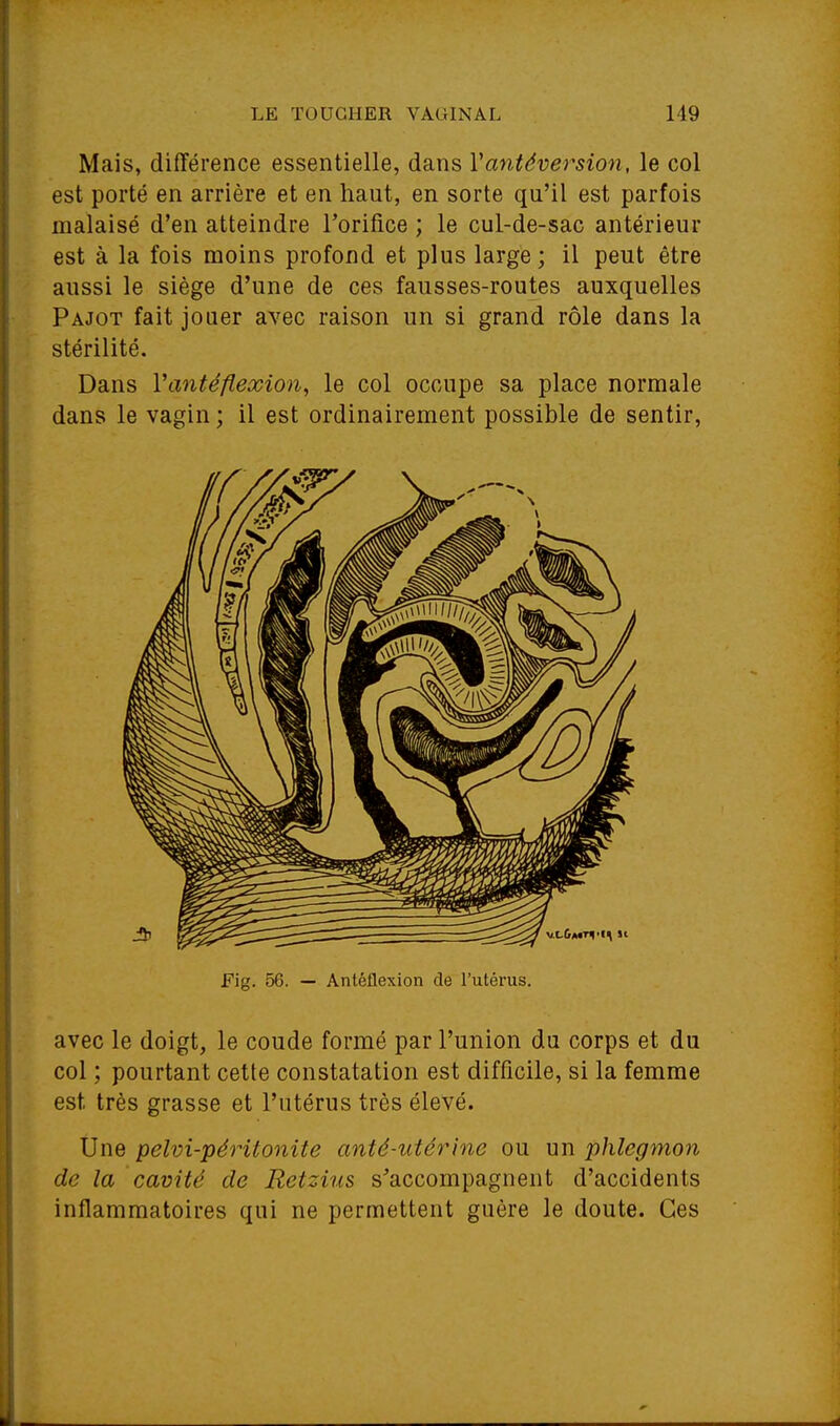 Mais, différence essentielle, dans Vantéversion, le col est porté en arrière et en haut, en sorte qu'il est parfois malaisé d'en atteindre l'orifice ; le cul-de-sac antérieur est à la fois moins profond et plus large; il peut être aussi le siège d'une de ces fausses-routes auxquelles Pajot fait jouer avec raison un si grand rôle dans la stérilité. Dans Vantéflexion, le col occupe sa place normale dans le vagin ; il est ordinairement possible de sentir, Fig. 56. — Antéflexion de l'utérus. avec le doigt, le coude formé par l'union du corps et du col ; pourtant cette constatation est difficile, si la femme est très grasse et l'utérus très élevé. Une pelvi-pérîtonite anté-utérinc ou un phlegmon de la cavité de Retzius s'accompagnent d'accidents inflammatoires qui ne permettent guère le doute. Ces