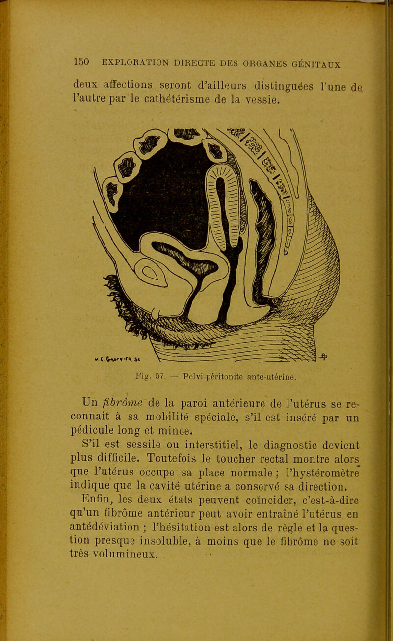 deux affections seront d'ailleurs distinguées l'une de l'autre par le cathétérisme de la vessie. Fig. 57. — Pelvi-péritonite anté-utérine. Un fibrôme de la paroi antérieure de l'utérus se re- connaît à sa mobilité spéciale, s'il est inséré par un pédicule long et mince. S'il est sessile ou interstitiel, le diagnostic devient plus difficile. Toutefois le toucher rectal montre alors que l'utérus occupe sa place normale ; l'hystéromètre indique que la cavité utérine a conservé sa direction. Enfin, les deux états peuvent coïncider, c'est-à-dire qu'un fibrome antérieur peut avoir entraîné l'utérus en antédéviation ; l'hésitation est alors de règle et la ques- tion presque insoluble, à moins que le fibrome ne soit très volumineux.