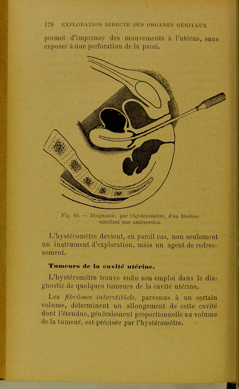 permet d'imprimer des mouvements à Tutéras, sans exposer à une perforation de la paroi. Fig. 65. — Diagnostic, par l'hystéromètre, d'un flbrôme simulant une antéversion. L'hystéromètre devient, en pareil cas, non seulement un instrument d'exploration, mais un agent de redres- sement. Tumeurs de la cavité utérine. L'hystéromètre trouve enfin son emploi dans le dia- gnostic de quelques tumeurs de la cavité utérine. Les fibrômes interstitiels, parvenus à un certain volume, déterminent un allongement de celte cavité dont l'étendue, généralement proportionnelle au volume de la tumeur, est précisée par l'hystéromètre. '