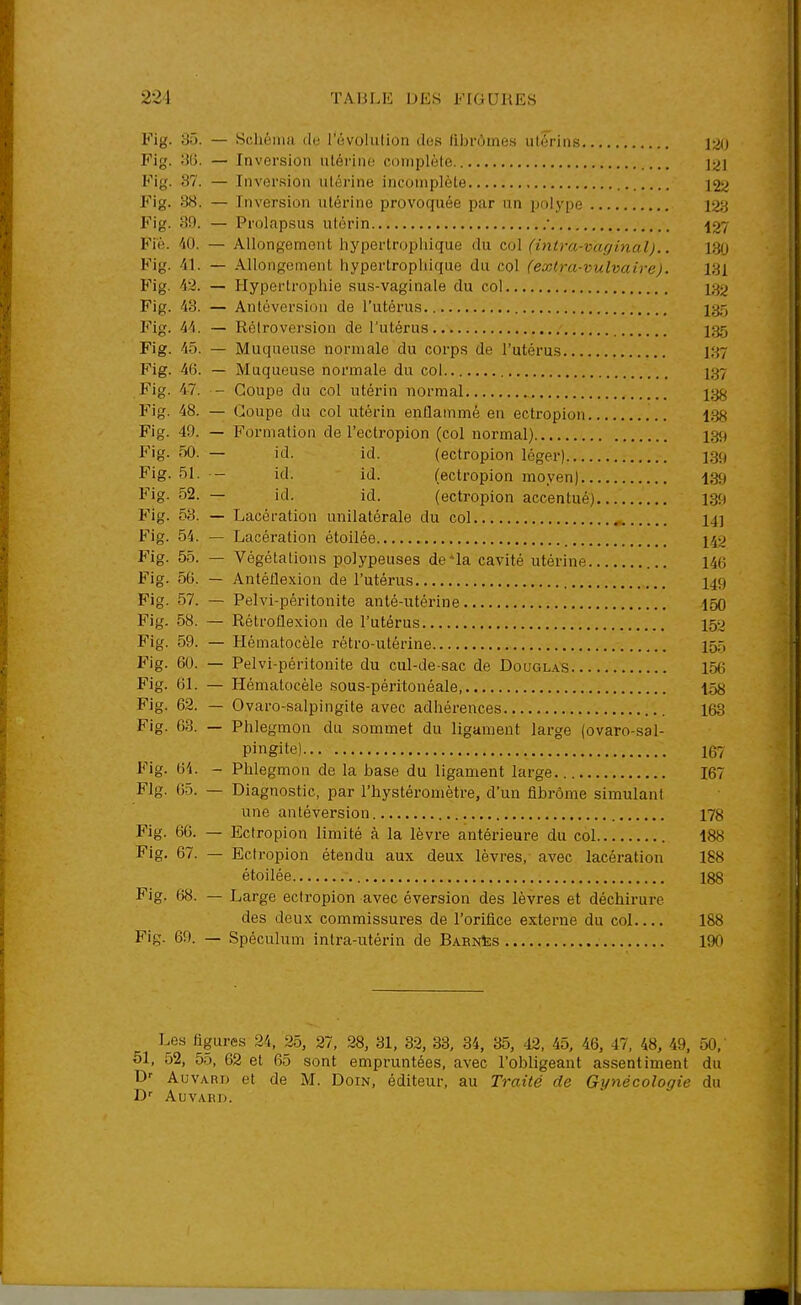 Fig. 35. — Schéma de rùvolulion des librômes utérins ]2U Fig. ;{(). — Inversion utérine complète 121 Fig. 87. — Inversion utérine incomplète 122 Fig. 38. — Inversion utérine provoquée par un polype 123 Fig. 39. — Prolapsus utérin • 137 Fie. 40. — Allongement hypertropliique du col (inira-vaginal).. 130 Fig. 41. — Allongement hypertropliique du col (extra-vulvaire). 131 Fig. 42. — Hypertrophie sus-vaginale du col 132 Fig. 43. — Anlôversion de l'utérus i;-j-, Fig. 44. — Rétroversion de l'utérus I35 Fig. 45. — Muqueuse normale du corps de l'utérus 1:^7 Fig. 46. — Muqueuse normale du col 1^7 Fig. 47. - Coupe du col utérin normal i;^^^ Fig. 48. — Coupe du col utérin enflammé en ectropion ISH Fig. 49. — Formation de l'ecti-opion (col normal) l3{^ Fig. 50. — id. id. (ectropion léger) ]3H Fig. 51. - id. id. (ectropion moyen) 439 Fig. 52. — id. id. (ectropion accentué) 139 î^ig. 53. — Lacération unilatérale du col 141 Fig. 54. — Lacération étoilée 142 Fig. 55. — Végétations polypeuses de*la cavité utérine 146 Fig. 56. — Antédexion de l'utérus I49 Fig. 57. — Pelvi-péritonite anté-utérine 150 Fig. 58. — Rélroilexion de l'utérus 152 Fig. 59. — Hématocèle rétro-utérine I55 Fig. 60. — Pelvi-péritonite du cul-de-sac de Dougl.'vs 156 Fig. 61. — Hématocèle sous-péritonéale 158 Fig. 62. — Ovaro-salpingite avec adhérences 163 Fig. 63. — Phlegmon du sommet du ligament large (ovaro-sal- Pingite) 167 Fig. 64. - Phlegmon de la base du ligament large 167 Fig. 05. — Diagnostic, par l'hystéromètre, d'un fibrome simulant une antéversion 178 Fig. 66. — Ectropion limité à la lèvre antérieure du col 188 Fig. 67. — Ectropion étendu aux deux lèvres, avec lacération 188 étoilée 188 Fig. 68. — Large ectropion avec éversion des lèvres et déchirure des deux commissures de l'orifice externe du col 188 Fig. 69. — Spéculum intra-utérin de Barnïis 190 Les figures 24. 25, 27, 28, 31, 32, 33, 34, 35, 42, 45, 46, 47, 48, 49, 50, 61, 52, 55, 62 et 65 sont empruntées, avec l'obligeant assentiment du D-- AuvARB et de M. Doin, éditeur, au Traité de Gynécologie du D' AUVARD. J