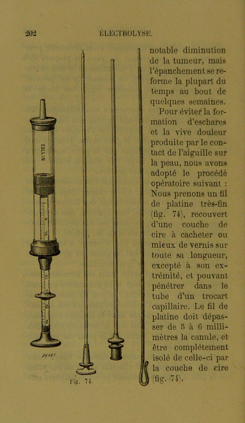 COLLIN 20:! ÉLIiCTKOLYStë. l-'ip. “i- notable diminution de la tumeur, mais l’épanchement se re- forme la plupart du temps au bout de quelques semaines. Pour évitei* la for- mation d’eschares et la vive douleur produite par le con- tact de l’aiguille sur la peau, nous avons adopté le procédé opératoire suivant : Nous prenons un lil de platine très-fin (fig. 74), recouvert d’une couche de cire à cacheter ou mieux de vernis sur toute sa longueur, excepté à son ex- trémité, et pouvant pénétrer dans le tube d’un trocart capillaire. Le fil de platine doit dépas- ser de n à 6 milli- mètres la canule, et être complètement isolé de celle-ci par la couche de cire l'(fig- =74).