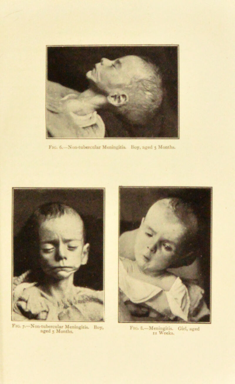 Fio. 6. Non-tubercular Meningitis. Boy, aged 5 Months. Flo. 7.—Non tnbcrcuUr Meningitis. Boy, aged 3 Months. Flo. 8.—Meningitis. Girl, aged