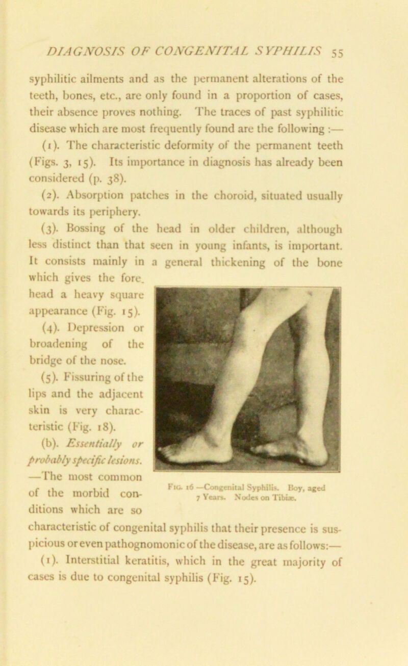 syphilitic ailments and as the permanent alterations of the teeth, bones, etc., are only found in a proportion of cases, their absence proves nothing. The traces of past syphilitic disease which are most frequently found are the following :— (1) . The characteristic deformity of the permanent teeth (Figs. 3, 15). Its importance in diagnosis has already been considered (p. 38). (2) . Absorption patches in the choroid, situated usually towards its periphery. (3) . Bossing of the head in older children, although less distinct than that seen in young infants, is important, it consists mainly in a general thickening of the bone which gives the fore, head a heavy square appearance (Fig. 15). (4) . Depression or broadening of the bridge of the nose. (5) . Fissuring of the lips and the adjacent skin is very charac- teristic (Fig. 18). (b). Essentially or probably specific lesions. —The most common of the morbid con- ditions which are so characteristic of congenital syphilis that their presence is sus- picious or even pathognomonic of the disease, are as follows:— (1). Interstitial keratitis, which in the great majority of cases is due to congenital syphilis (Fig. 15). F to. 16 —Congenital Syphilis. Boy, aged