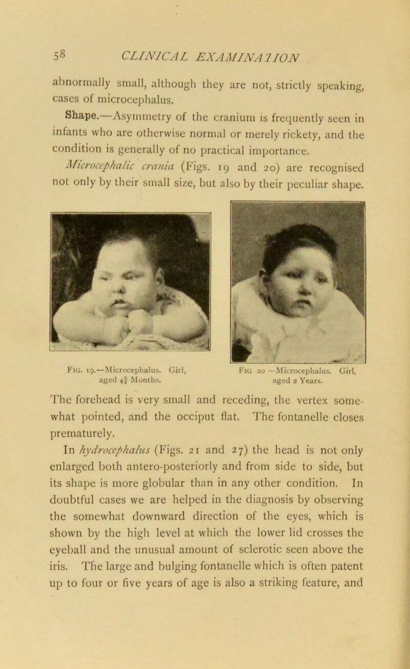 abnormally small, although they are not, strictly speaking, cases of microcephalus. Shape.—Asymmetry of the cranium is frequently seen in infants who are otherwise normal or merely rickety, and the condition is generally of no practical importance. Microcephalic crania (Figs. 19 and 20) are recognised not only by their small size, but also by their peculiar shape. The forehead is very small and receding, the vertex some- what pointed, and the occiput flat. The fontanelle closes prematurely. In hydrocephalus (Figs. 21 and 27) the head is not only enlarged both antero-posteriorly and from side to side, but its shape is more globular than in any other condition. In doubtful cases we are helped in the diagnosis by observing the somewhat downward direction of the eyes, which is shown by the high level at which the lower lid crosses the eyeball and the unusual amount of sclerotic seen above the iris. The large and bulging fontanelle which is often patent up to four or five years of age is also a striking feature, and Fig. 19.—Microcephalus. Girl, aged 43 Months, Fig 20 —Microcephalus. Girl, aged 2 Years.