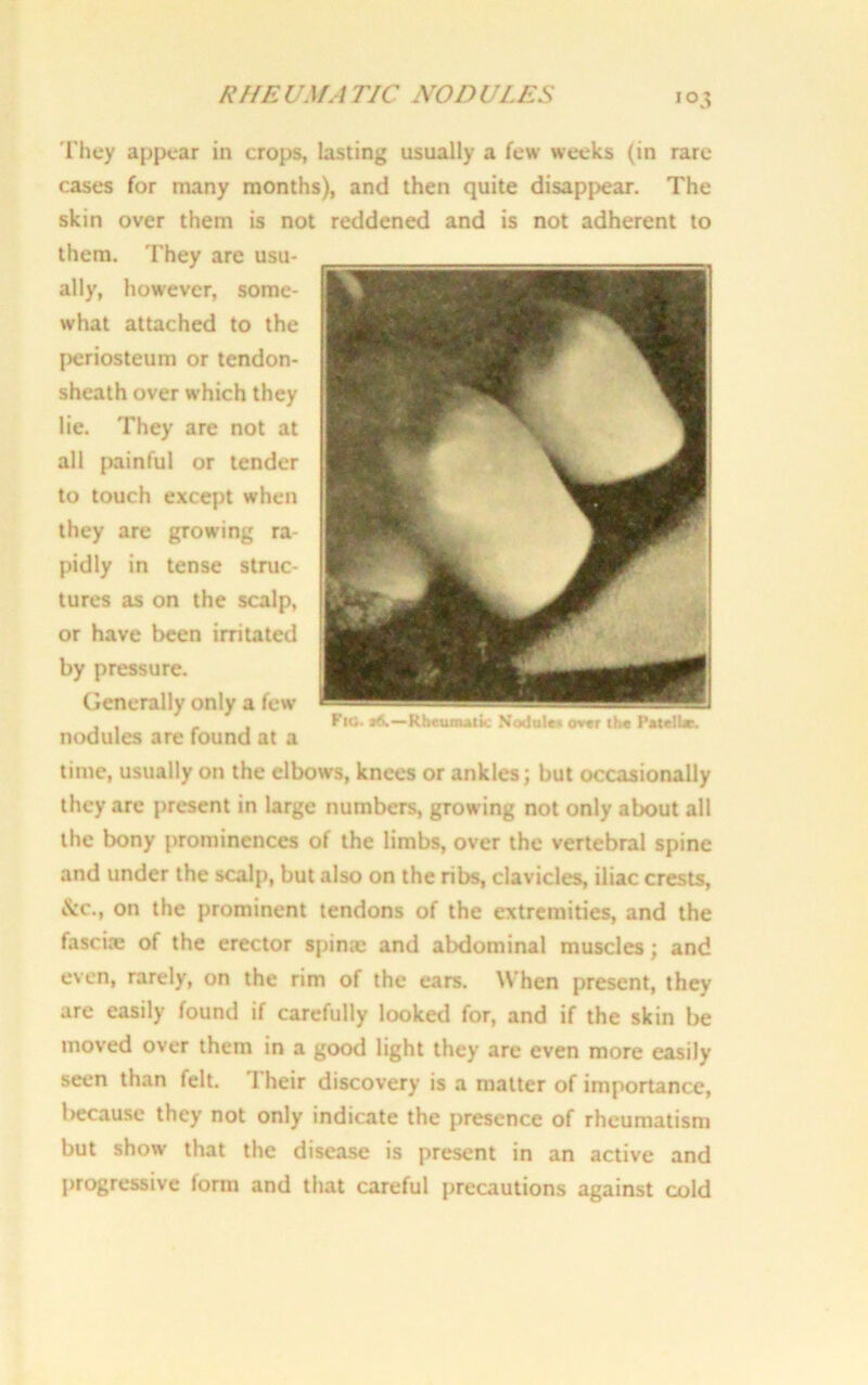 R HE UMA TIC NOD CUES «°3 'Fhey appear in crops, lasting usually a few weeks (in rare cases for many months), and then quite disappear. The skin over them is not reddened and is not adherent to them. They are usu- ally, however, some- what attached to the periosteum or tendon- sheath over which they lie. They are not at all painful or tender to touch except when they are growing ra- pidly in tense struc- tures as on the scalp, or have been irritated by pressure. Generally only a few nodules are found at a time, usually on the elbows, knees or ankles; but occasionally they are present in large numbers, growing not only about all the bony prominences of the limbs, over the vertebral spine and under the scalp, but also on the ribs, clavicles, iliac crests, &c., on the prominent tendons of the extremities, and the fascue of the erector spin® and abdominal muscles; and even, rarely, on the rim of the ears. When present, they are easily found if carefully looked for, and if the skin be moved over them in a good light they are even more easily seen than felt. Their discovery is a matter of importance, because they not only indicate the presence of rheumatism but show that the disease is present in an active and progressive form and that careful precautions against cold Fig. f&—Rheumatic Nodule* over the Patcibe.