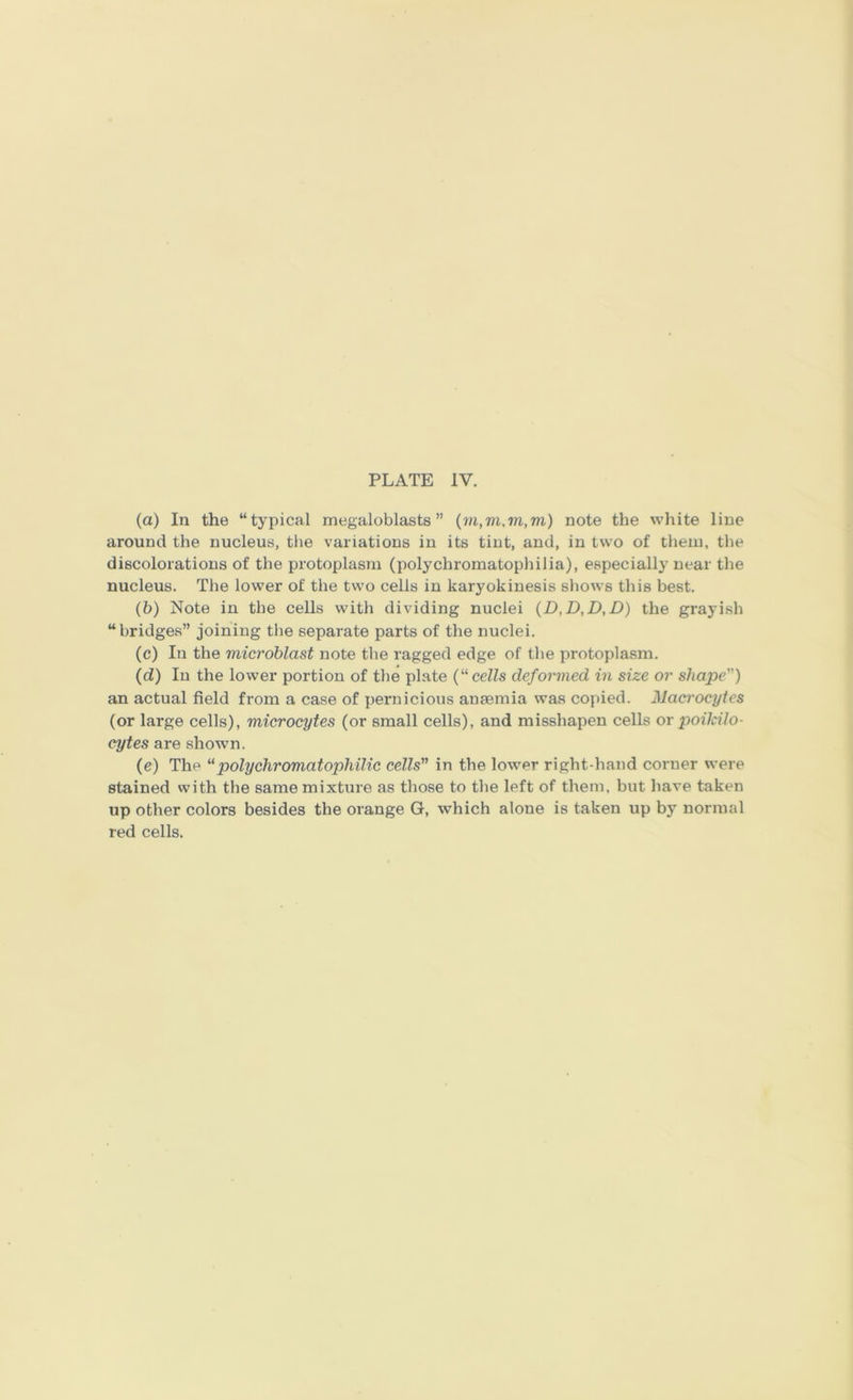 PLATE IV. (а) In the “typical megaloblasts ” note the white line around the nucleus, tlie variations in its tint, and, in two of them, the discolorations of the protoplasm (polychromatophilia), especially near tlie nucleus. The lower of the two cells in karyokinesis shows this best. (б) Note in the cells with dividing nuclei (D,D,D,D) the grayish “bridges” joining the separate parts of the nuclei. (c) In the micrdblast note the ragged edge of tlie protoplasm. (d) In the lower portion of the plate (“cells deformed in size or shape) an actual field from a case of pernicious anaemia was copied. Macrocytes (or large cells), microcytes (or small cells), and misshapen cells or poikiIo- cytes are shown. (e) The “polychromatophilic cells in the lower right-hand corner were stained with the same mixture as those to the left of them, but have taken up other colors besides the orange G, which alone is taken up by normal red cells.