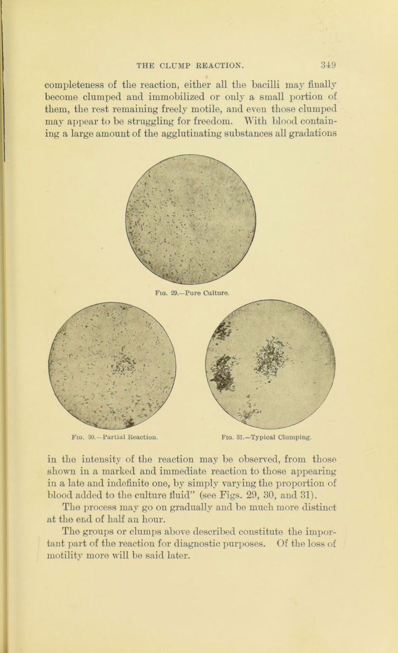 completeness of tlie reaction, either all the bacilli may finally become clumped and immobilized or only a small portion of them, the rest remaining freely motile, and even those clumped may appear to be struggling for freedom. With blood contain- ing a large amount of the agglutinating substances all gradations Fig. 29.—Pure Culture. Fig. 30.—Partial Reaction. Fig. 31.—Typical Clumping. in the intensity of the reaction may be observed, from those shown in a marked and immediate reaction to those appearing in a late and indefinite one, by simply varying the proportion of blood added to the culture fluid” (see Figs. 29, 30, and 31). The jirocess may go on gradually and be much more distinct at the end of half an hour. The groups or clumps above described constitute the impor- tant part of the reaction for diagnostic purposes. Of the loss of motility more will be said later.