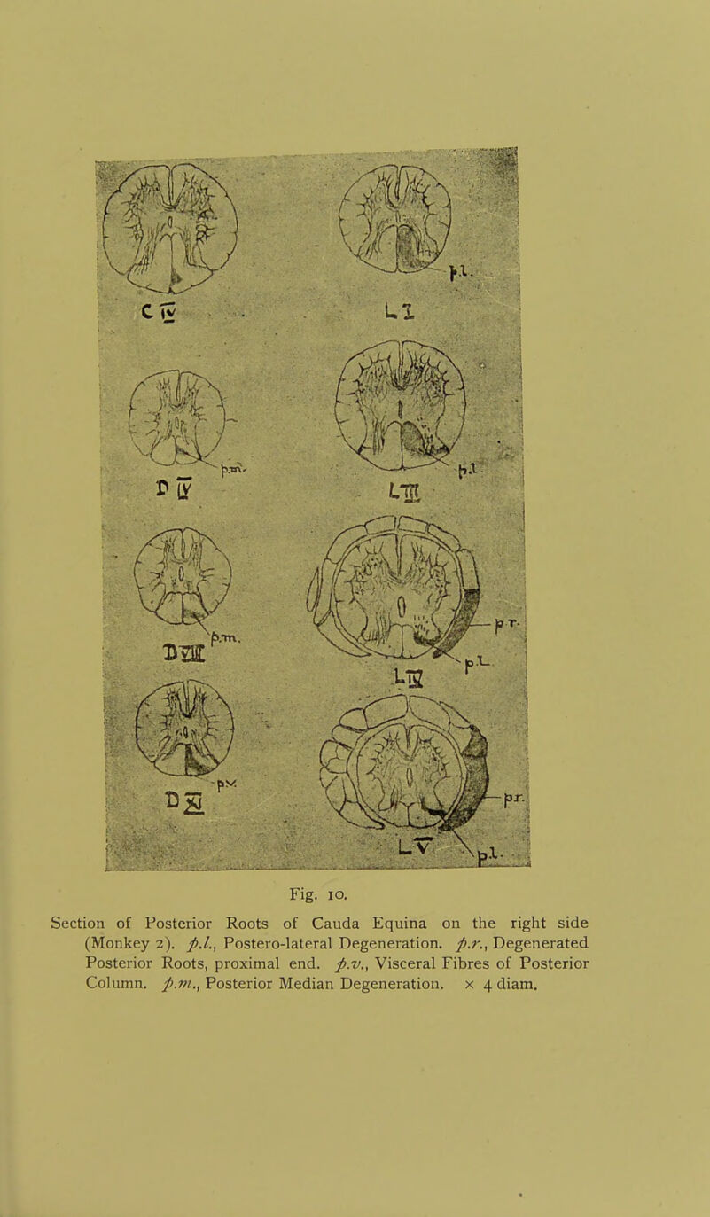 CTv . LI Fig. lo. Section of Posterior Roots of Cauda Equina on the right side (Monkey 2). p.I., Postero-lateral Degeneration, p.r., Degenerated Posterior Roots, proximal end. p.v., Visceral Fibres of Posterior Column, p.m., Posterior Median Degeneration, x 4 diam.