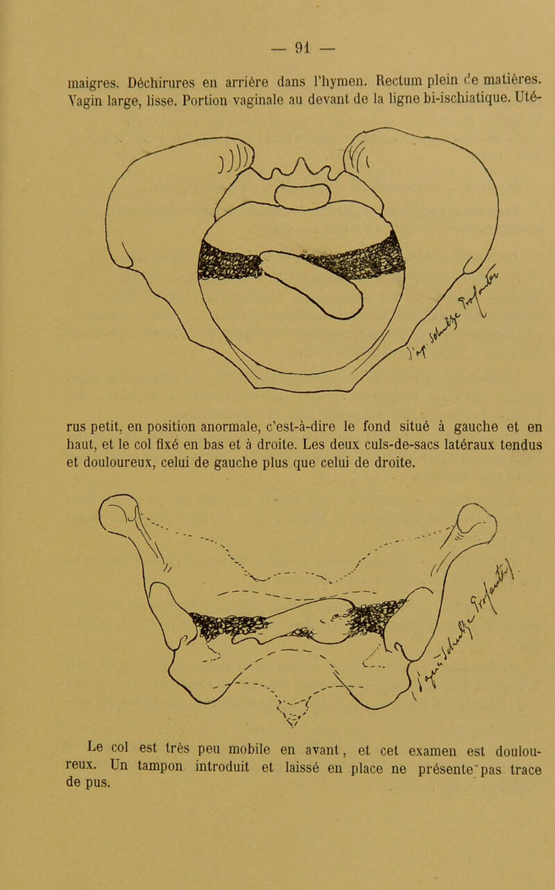 maigres. Déchirures en arrière dans l’hymen. Rectum plein de matières. Vagin large, lisse. Portion vaginale au devant de la ligne bi-ischiatique. Uté- rus petit, en position anormale, c’est-à-dire le fond situé à gauche et en haut, et le col fixé en bas et à droite. Les deux culs-de-sacs latéraux tendus et douloureux, celui de gauche plus que celui de droite. Le col est très peu mobile en avant, et cet examen est doulou- reux. Un tampon introduit et laissé en place ne présenteras trace de pus.