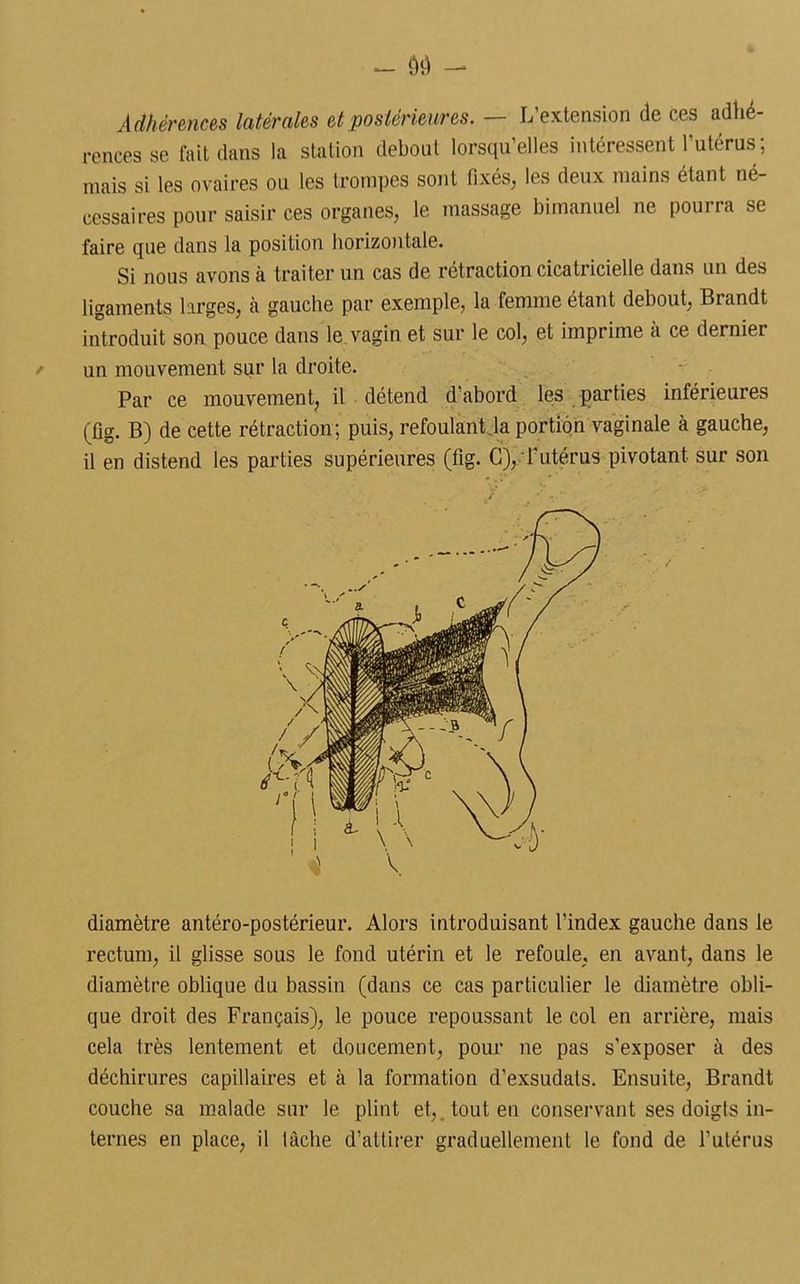 Adhérences latérales et postérieures. — L'extension de ces adhé- rences se fait dans la station debout lorsqu’elles intéressent l'utérus; mais si les ovaires ou les trompes sont fixés, les deux mains étant né- cessaires pour saisir ces organes, le massage bimanuel ne pourra se faire que dans la position horizontale. Si nous avons à traiter un cas de rétraction cicatricielle dans un des ligaments larges, à gauche par exemple, la femme étant debout, Brandt introduit son pouce dans le. vagin et sur le col, et imprime à ce dernier un mouvement sur la droite. Par ce mouvement, il détend d’abord les parties inférieures (fig. B) de cette rétraction; puis, refoulant la portion vaginale à gauche, il en distend les parties supérieures (fig. G),/f utérus pivotant sur son diamètre antéro-postérieur. Alors introduisant l’index gauche dans le rectum, il glisse sous le fond utérin et le refoule, en avant, dans le diamètre oblique du bassin (dans ce cas particulier le diamètre obli- que droit des Français), le pouce repoussant le col en arrière, mais cela très lentement et doucement, pour ne pas s’exposer à des déchirures capillaires et à la formation d’exsudats. Ensuite, Brandt couche sa malade sur le plint et,, tout en conservant ses doigts in- ternes en place, il lâche d’attirer graduellement le fond de l’utérus